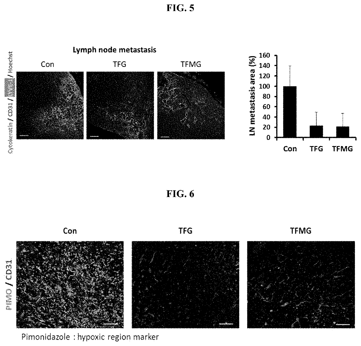 Composition for treating cancer or inhibiting cancer metastasis, including tfg or tfmg nanoparticles