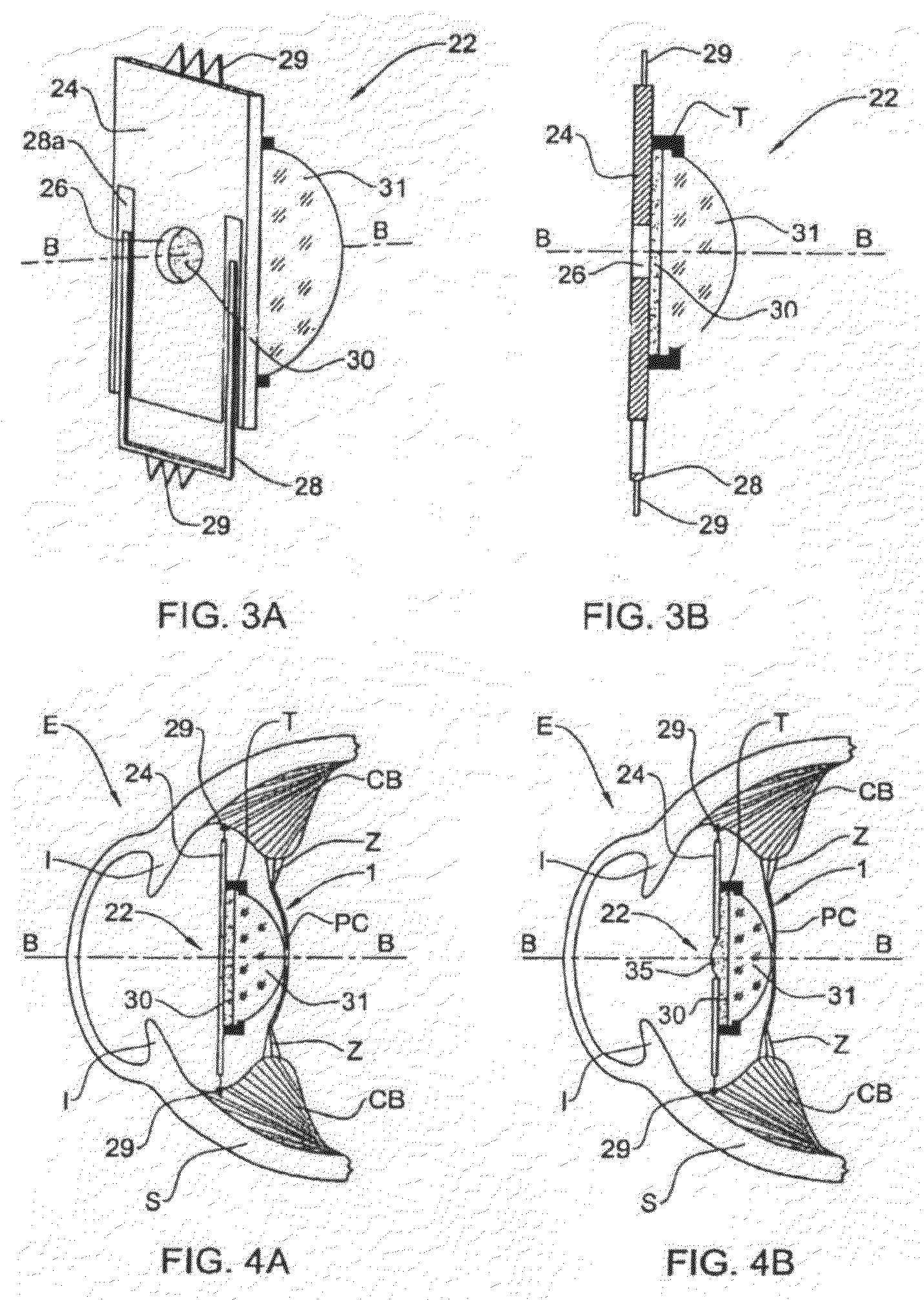 Accommodating lens assembly