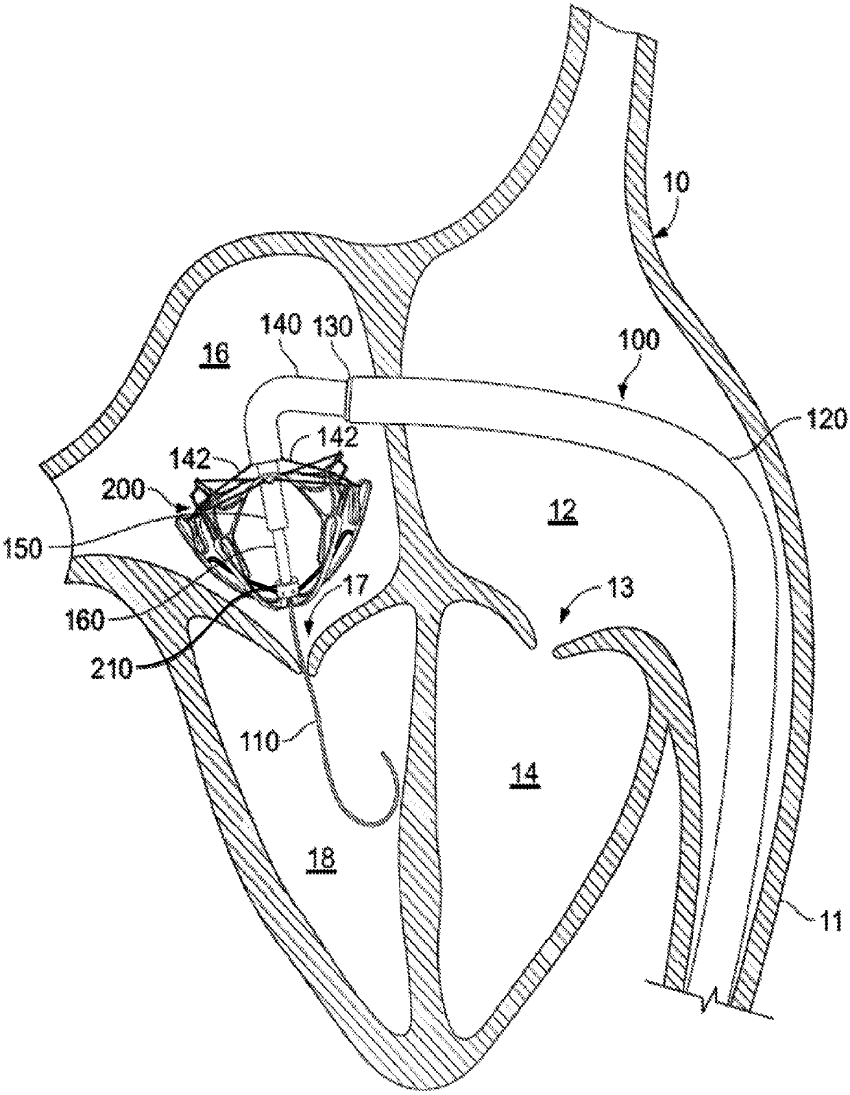 Systems and methods for heart valve therapy