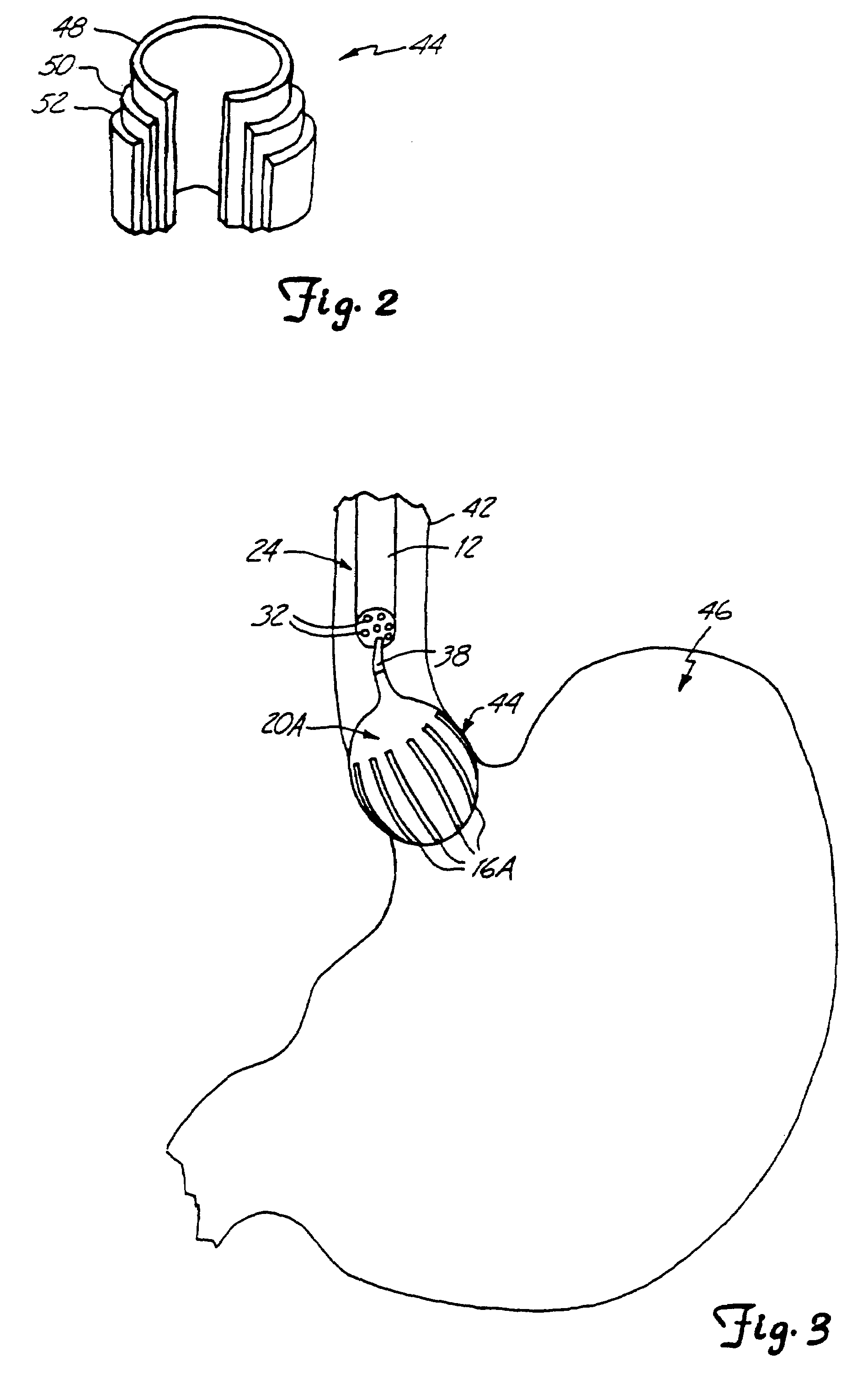 Device and method for treatment of gastroesophageal reflux disease