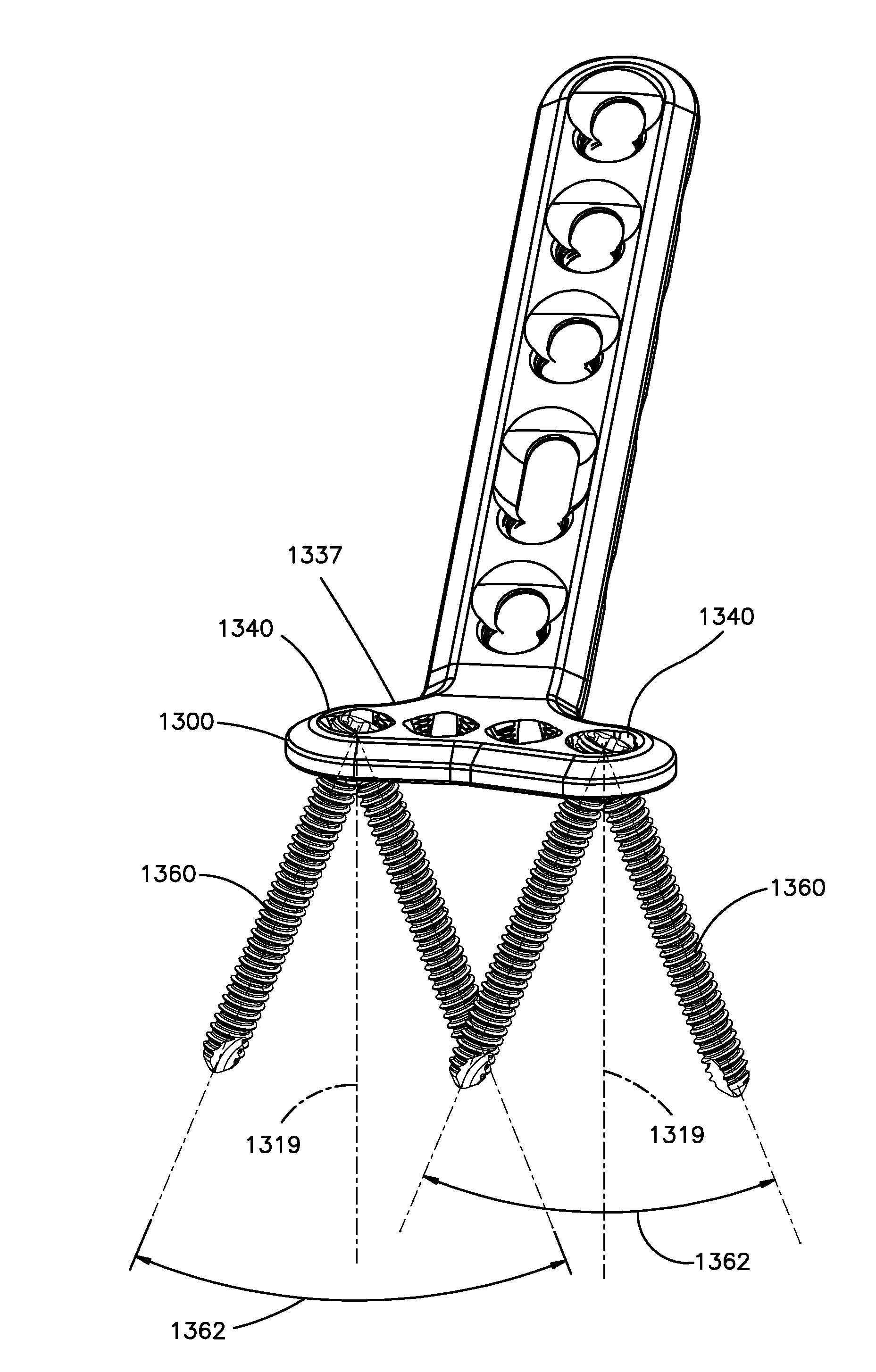 Highly-Versatile Variable-Angle Bone Plate System