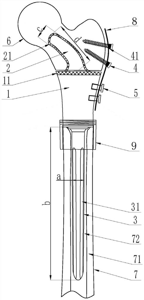 Femoral prosthesis for retaining femoral head