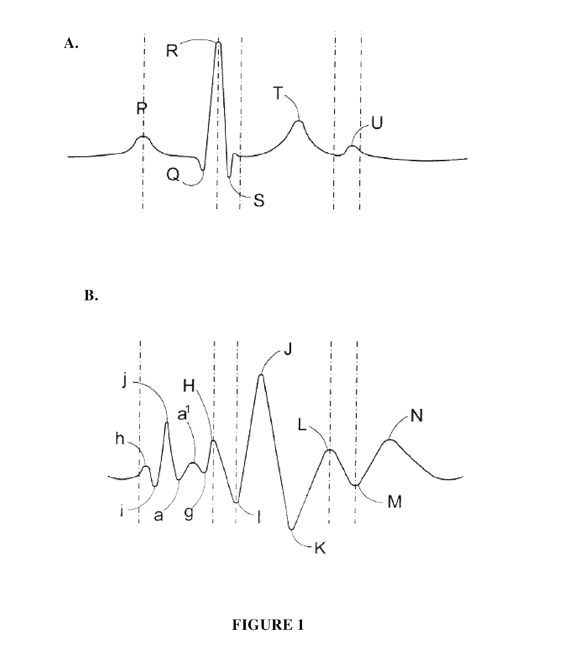 Method and apparatus for obtaining and processing ballistocardiograph data
