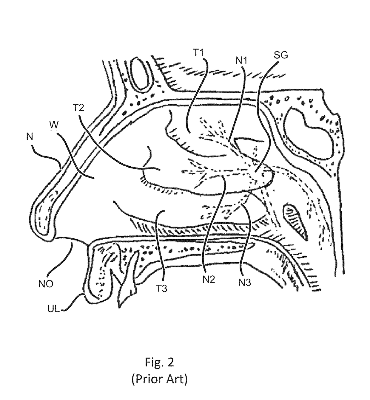 Devices and methods for treating a lateral surface of a nasal cavity