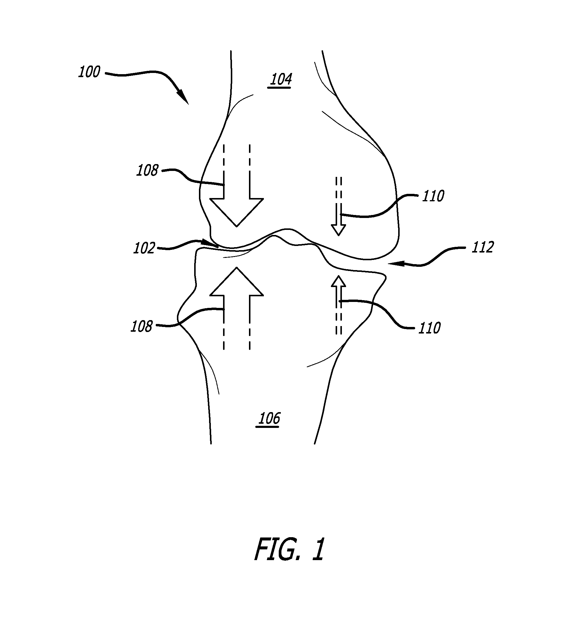Load Transferring Systems and Methods for Transferring Load in a Joint