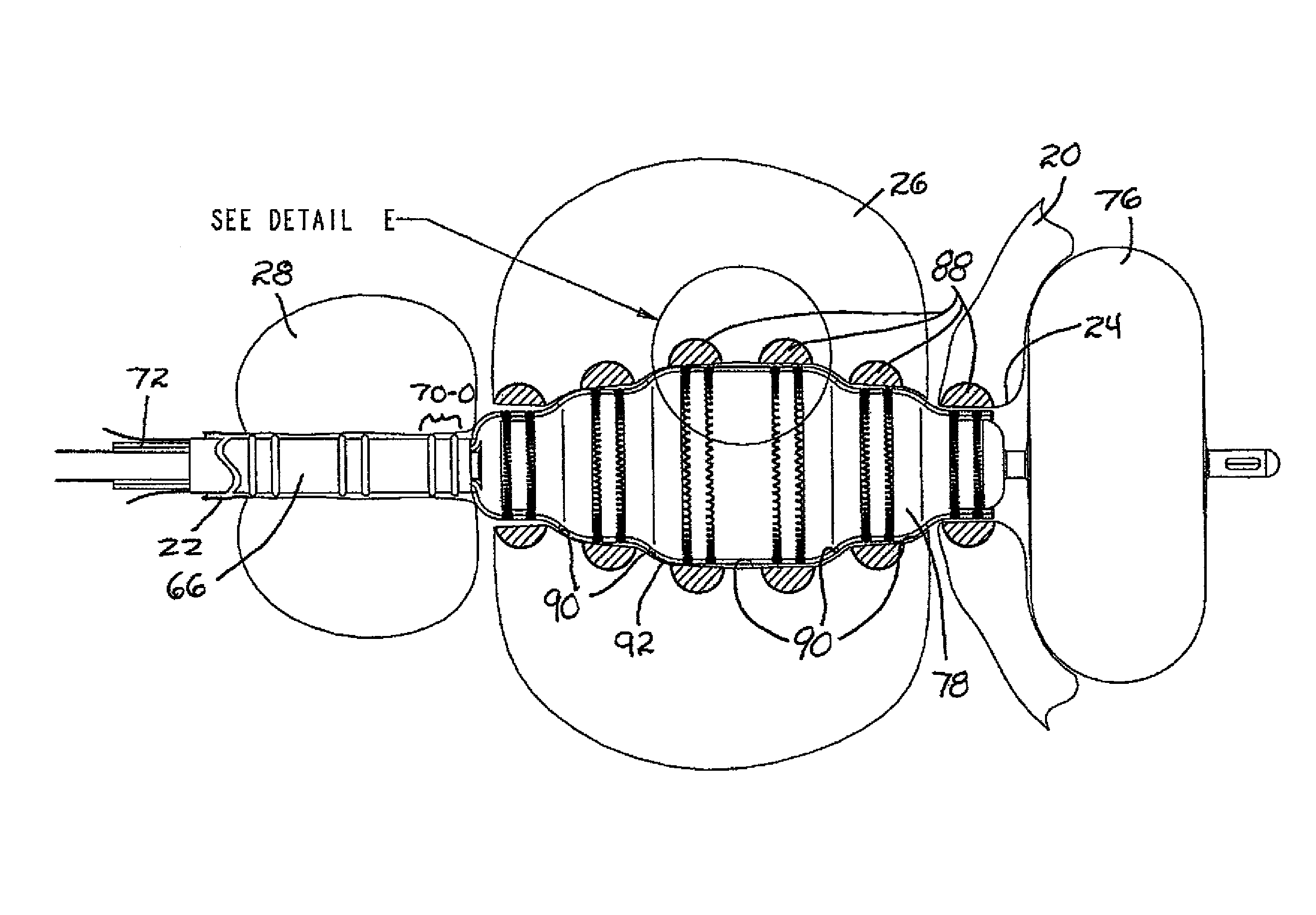 Method and apparatus for remodeling/profiling a tissue lumen, particularly in the urethral lumen in the prostate gland