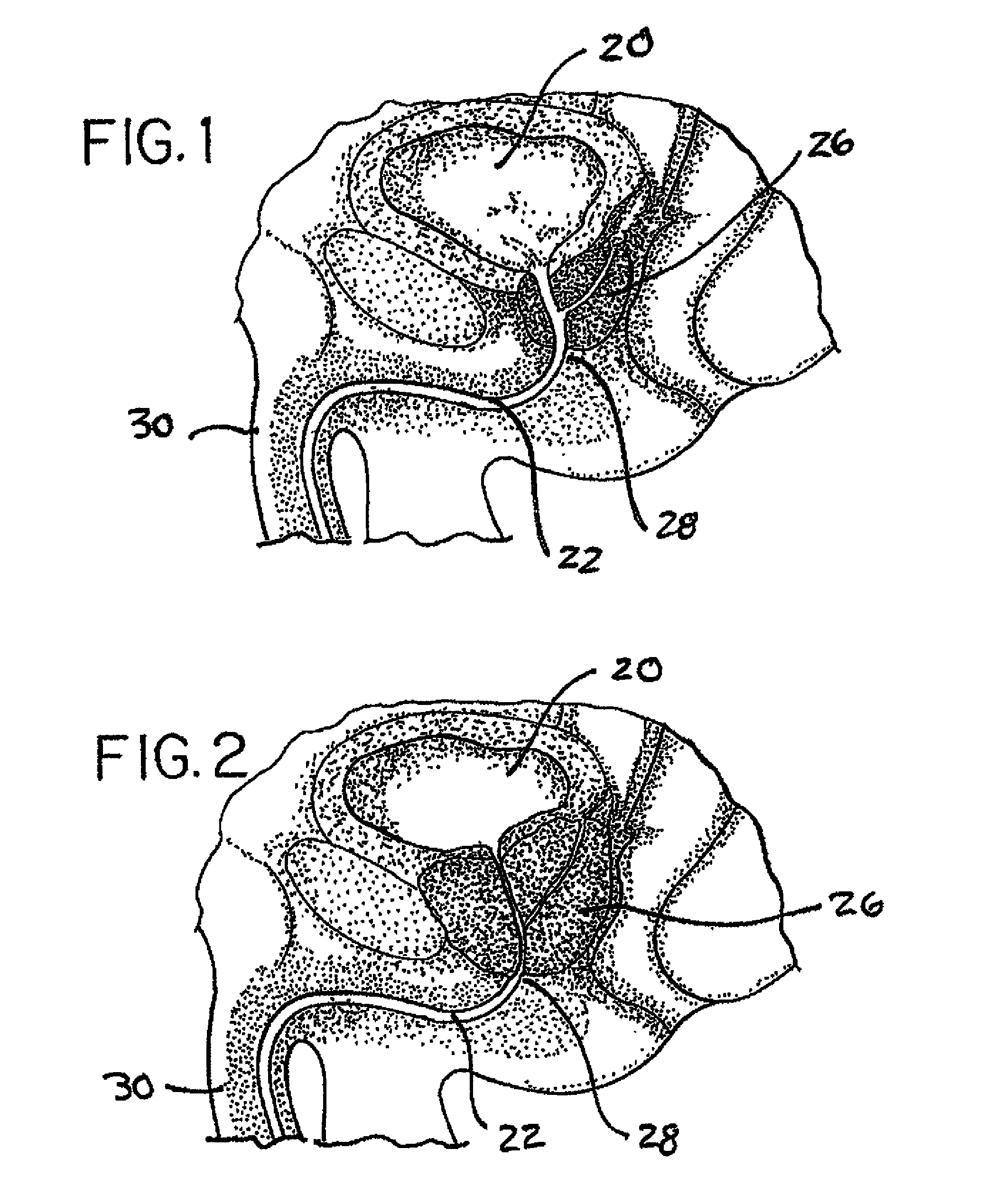 Method and apparatus for remodeling/profiling a tissue lumen, particularly in the urethral lumen in the prostate gland