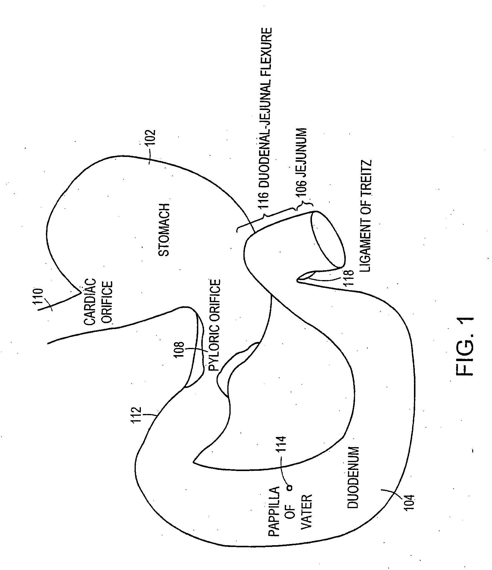 Methods of treatment using a bariatric sleeve