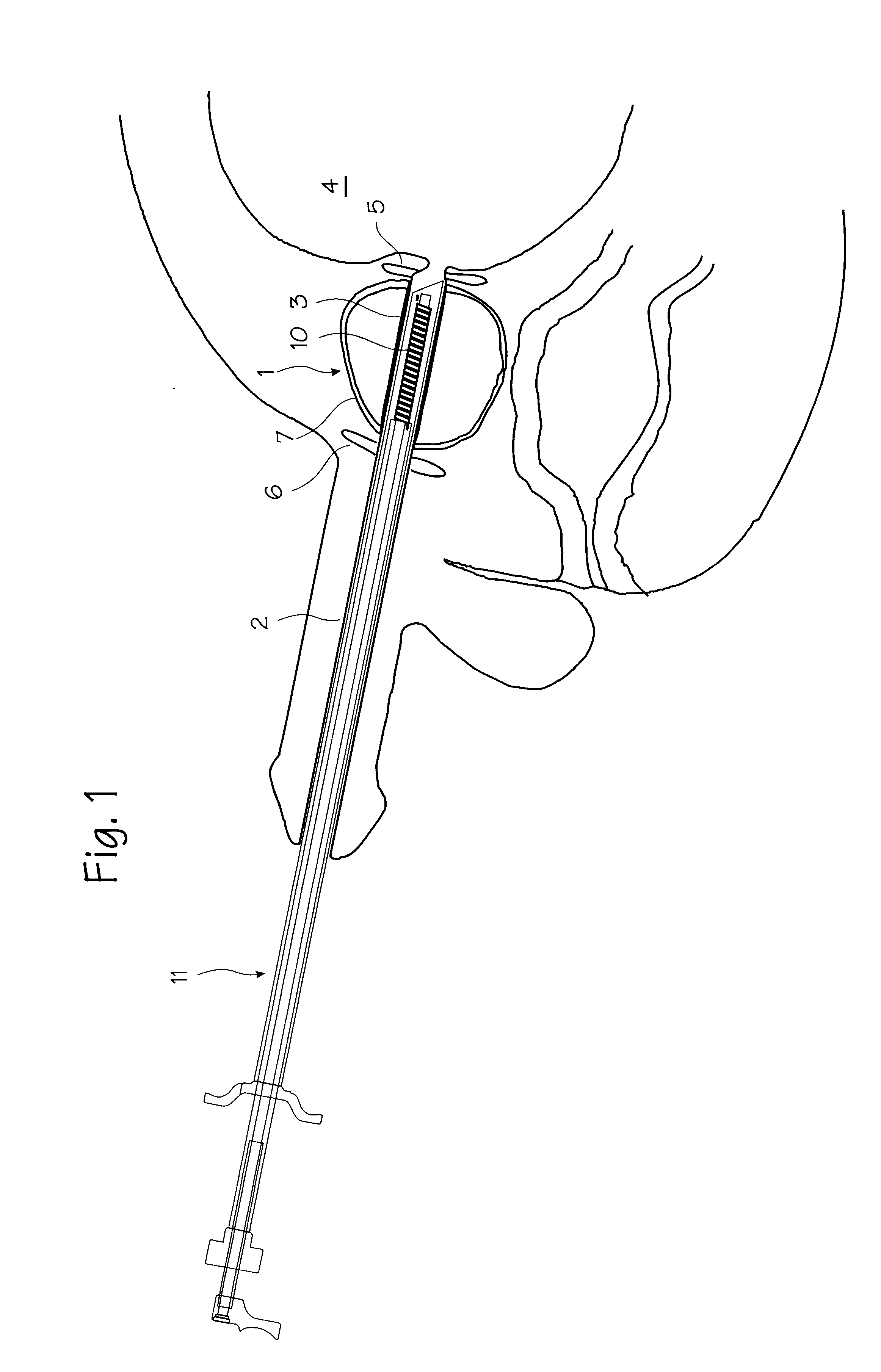 Stent delivery system