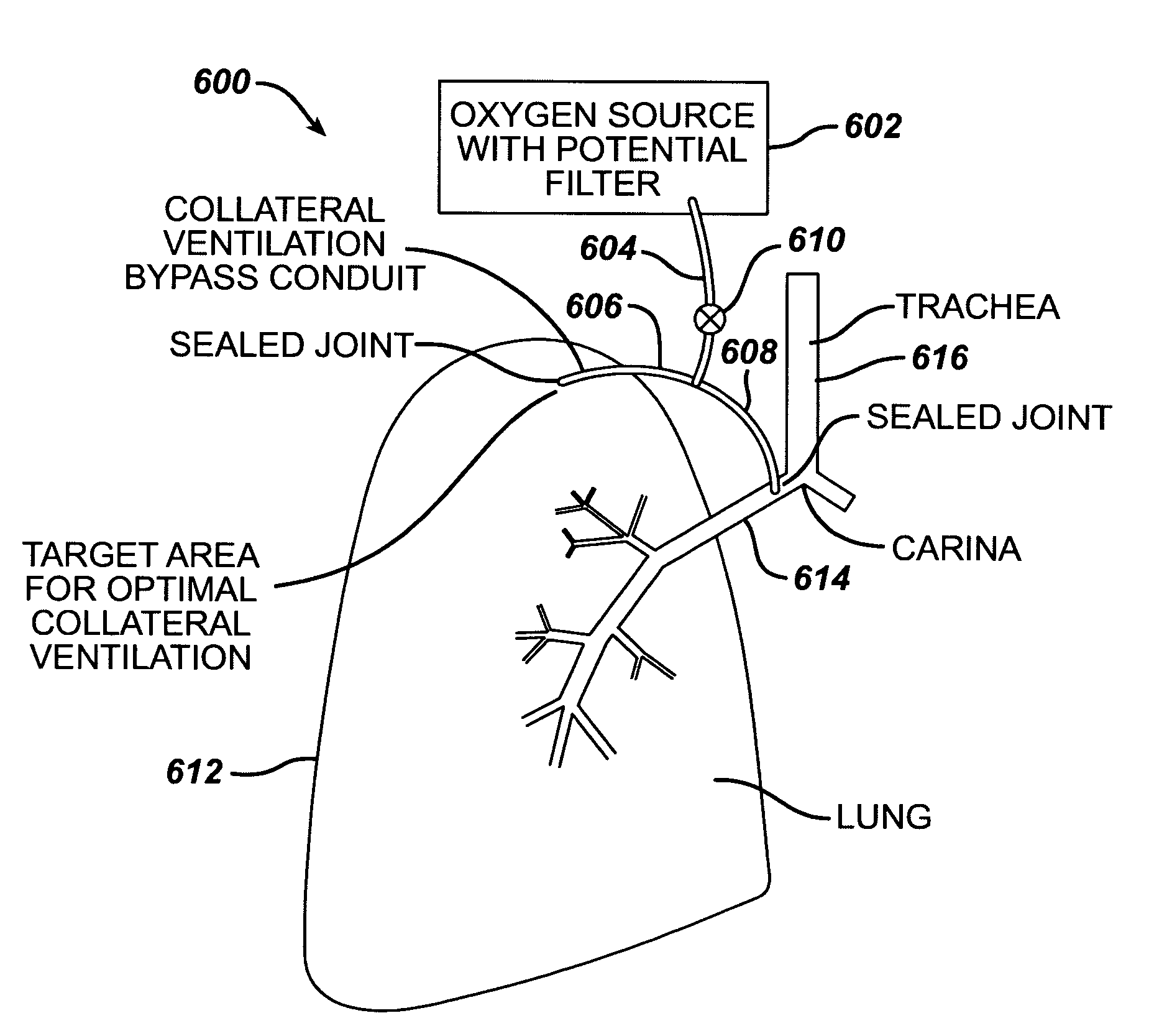 Intra-thoracic collateral ventilation bypass system and method