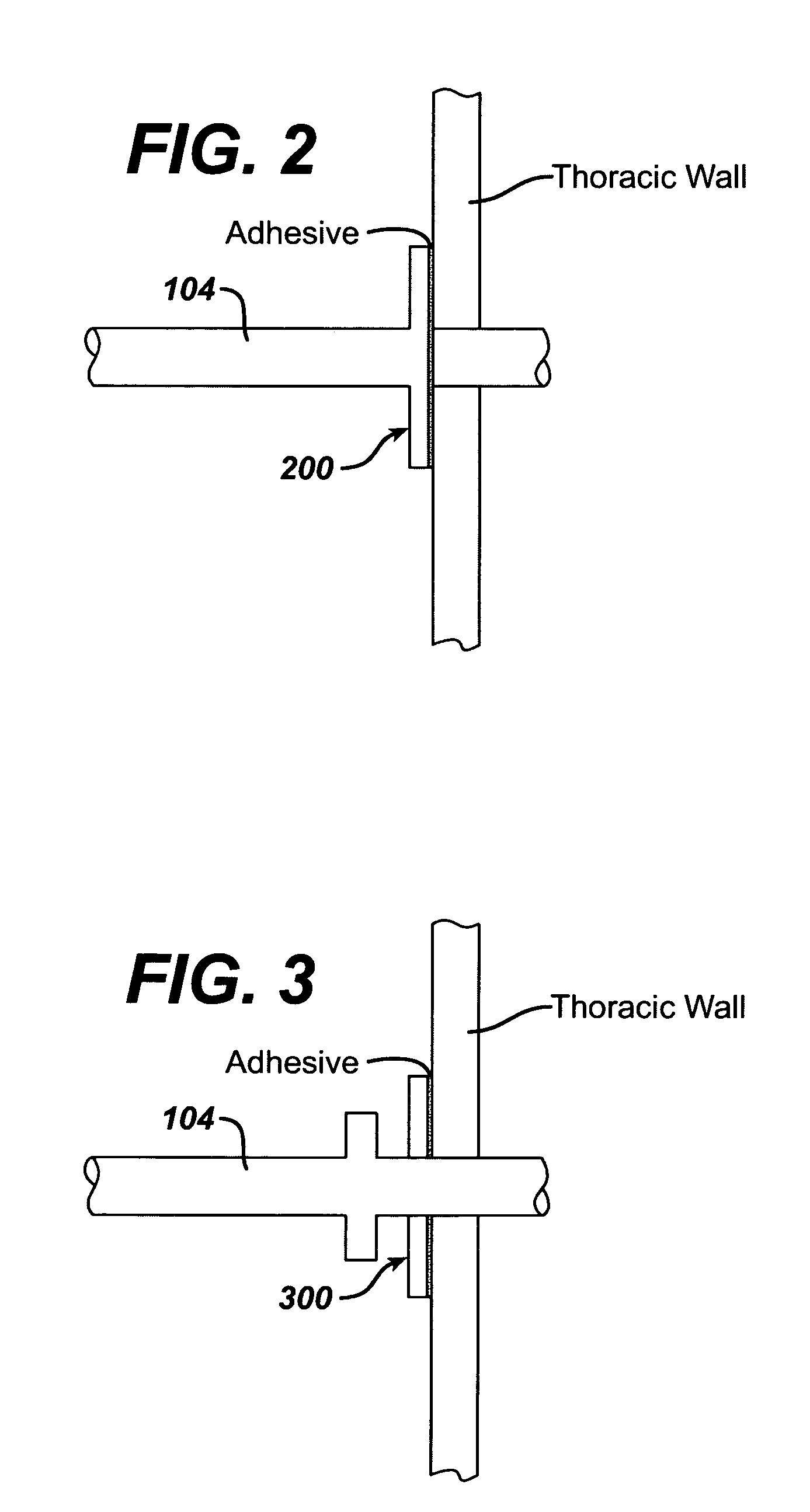 Intra-thoracic collateral ventilation bypass system and method