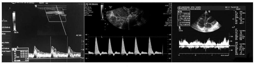 An automatic identification method of blood flow velocity waveform based on ultrasound image