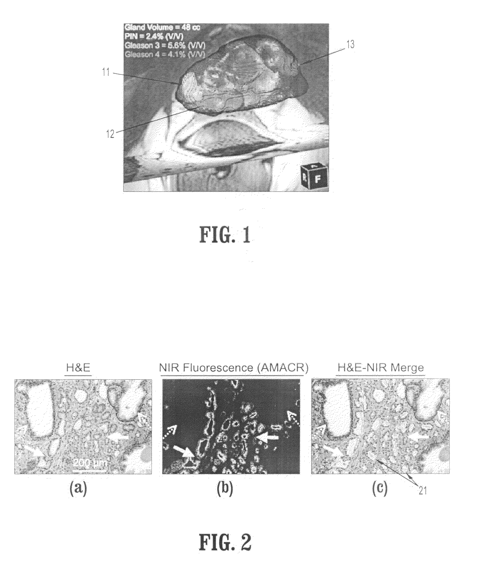 System and method for unsupervised detection and gleason grading of prostate cancer whole mounts using NIR fluorscence