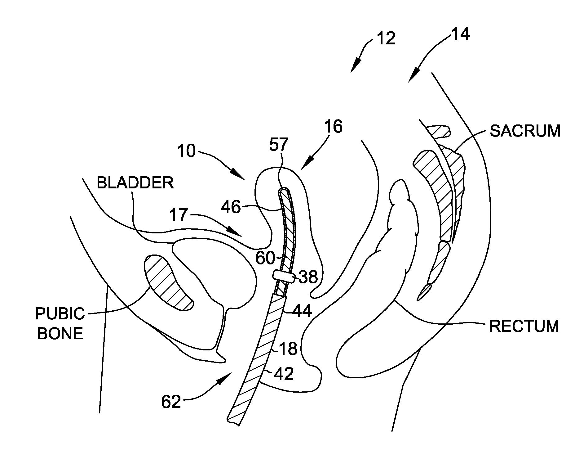 Gynecological brachytherapy applicator for use in mr-guided intracavitary brachytherapy