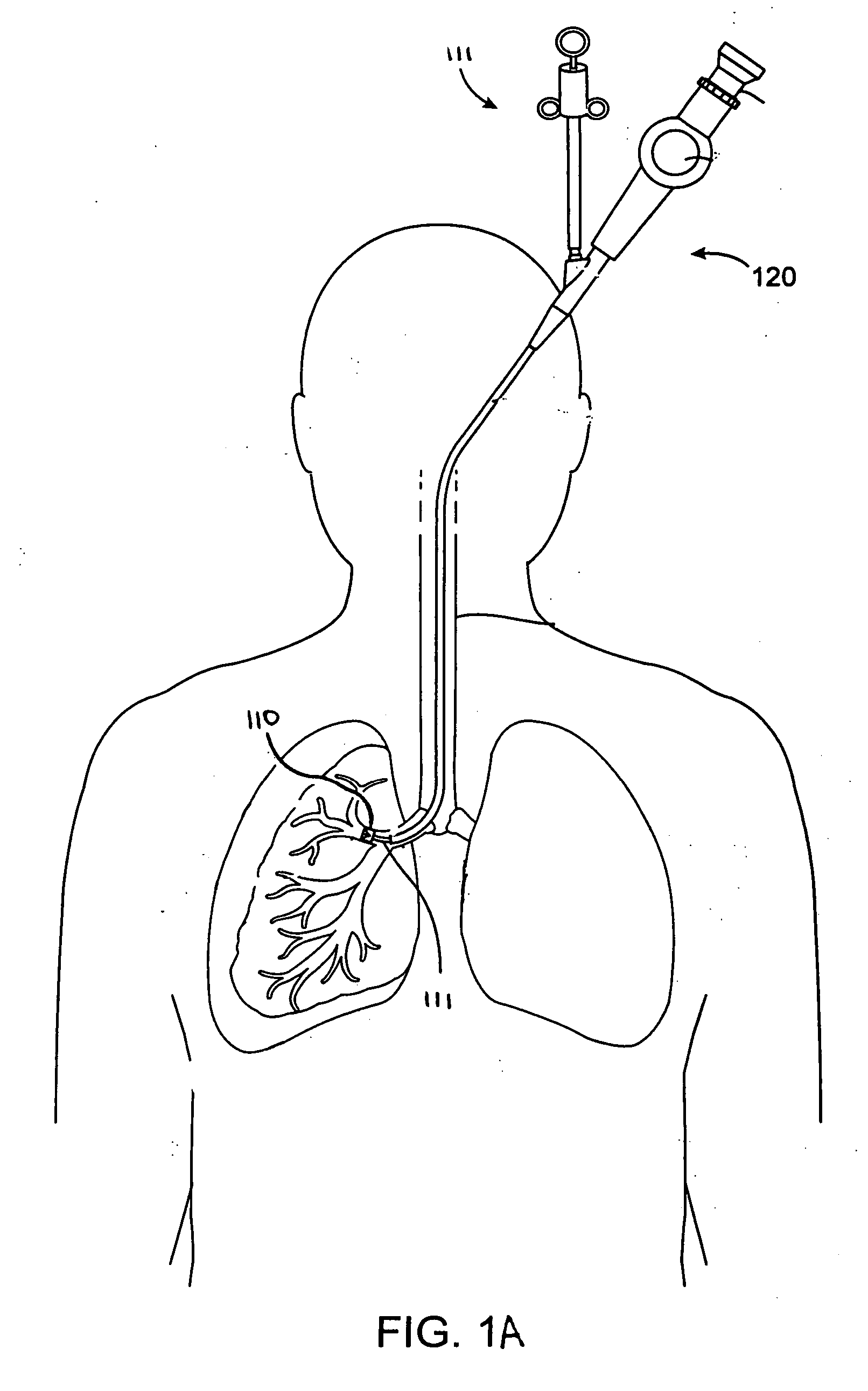 Treatment planning with implantable bronchial isolation devices