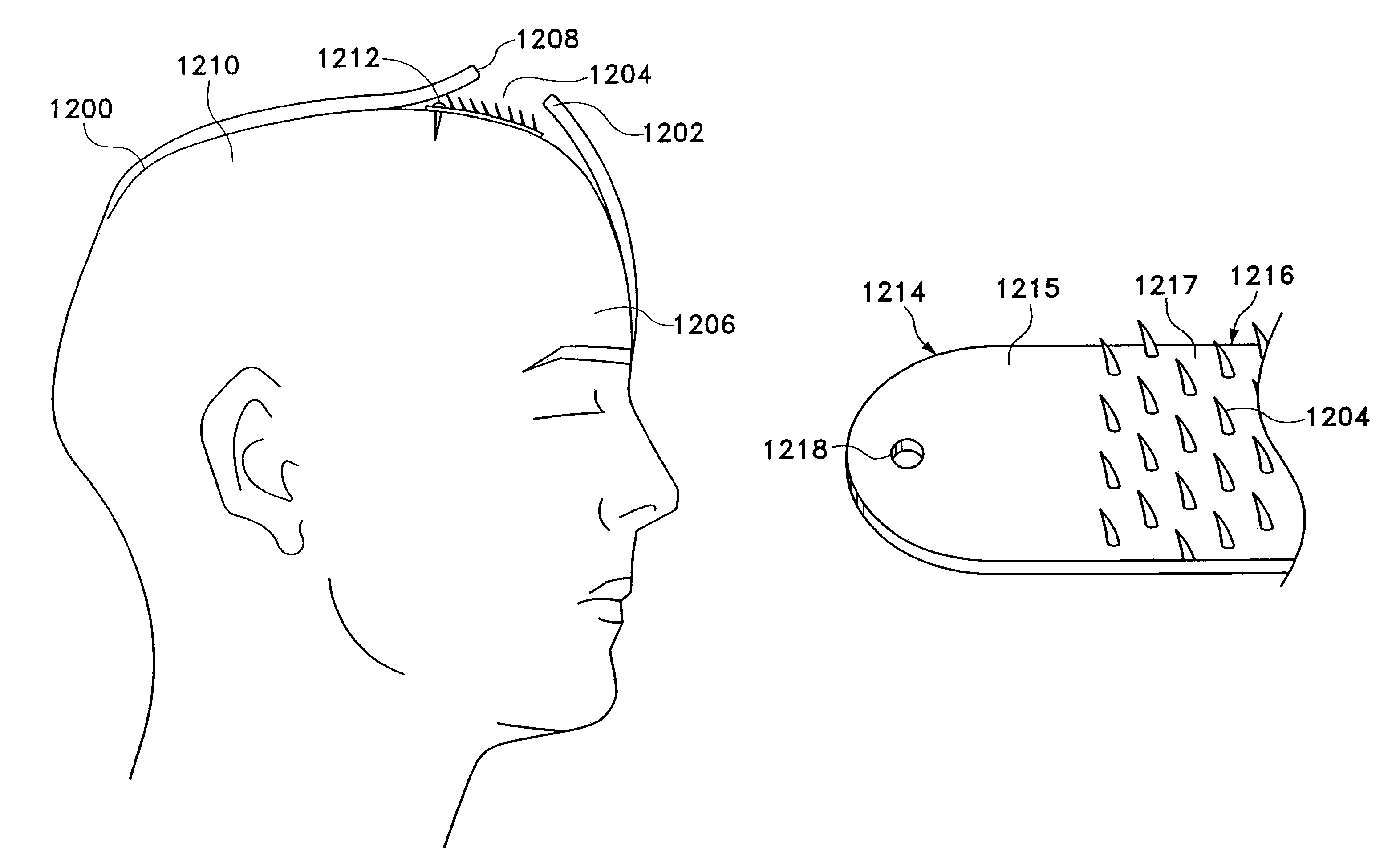 Multi-point tissue tension distribution device and method, a chin lift variation