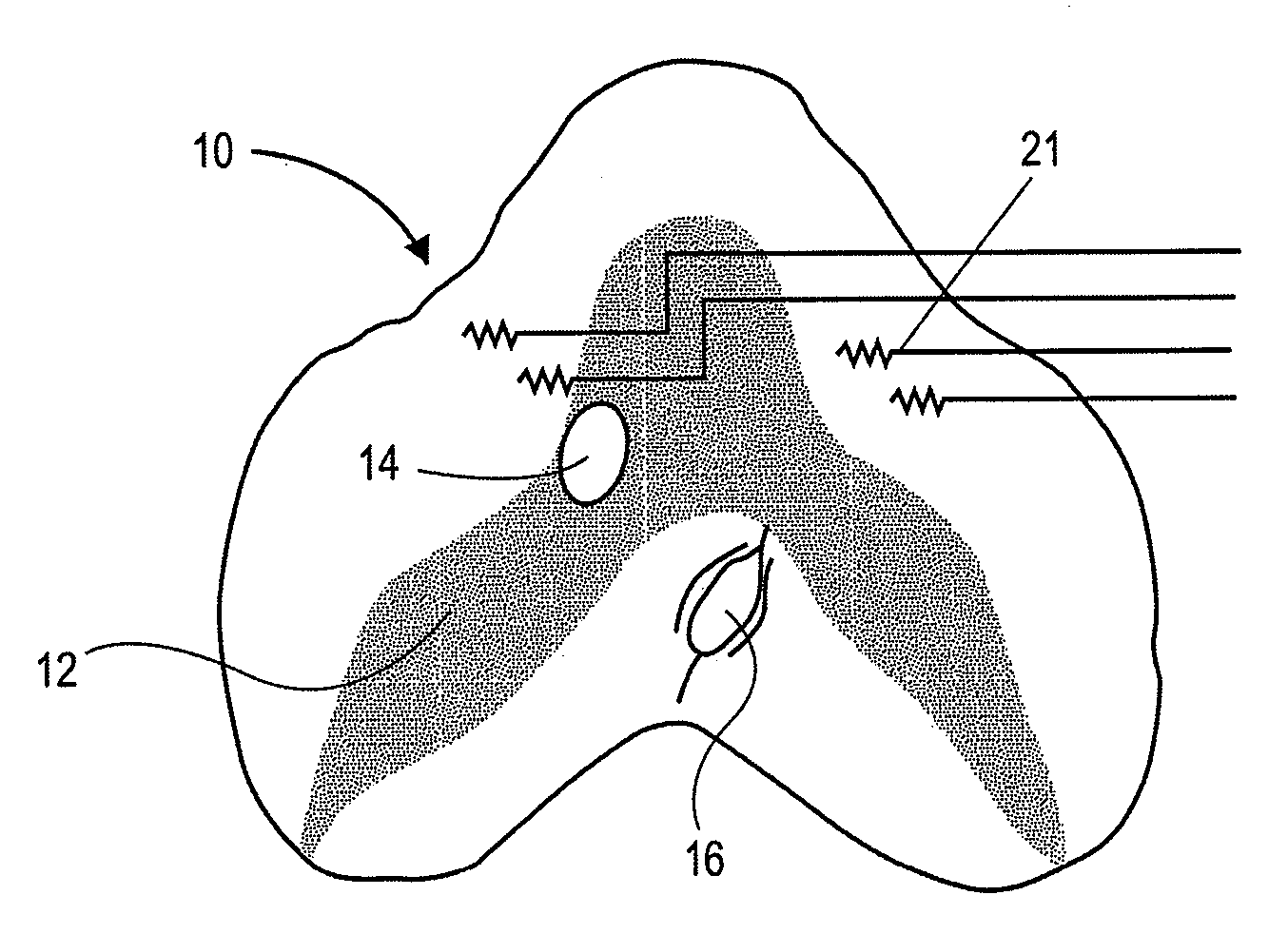 Devices and methods for assessing motor point electromyogram as a biomarker