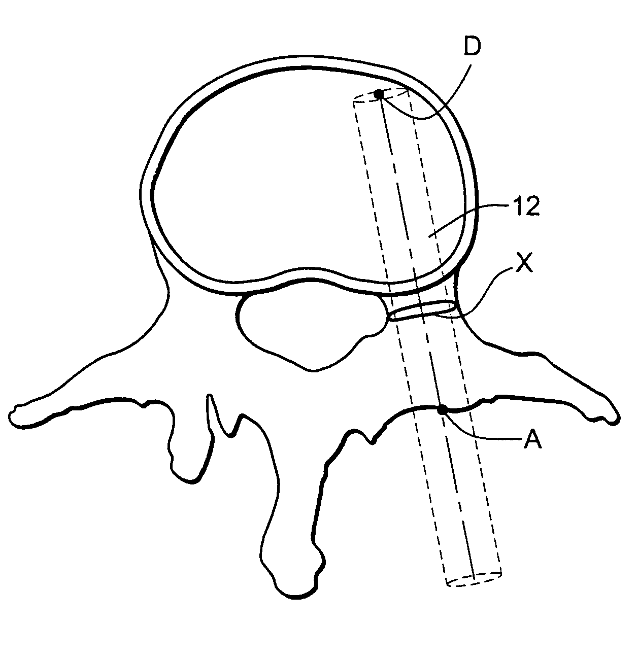 Method of improving pedicle screw placement in spinal surgery