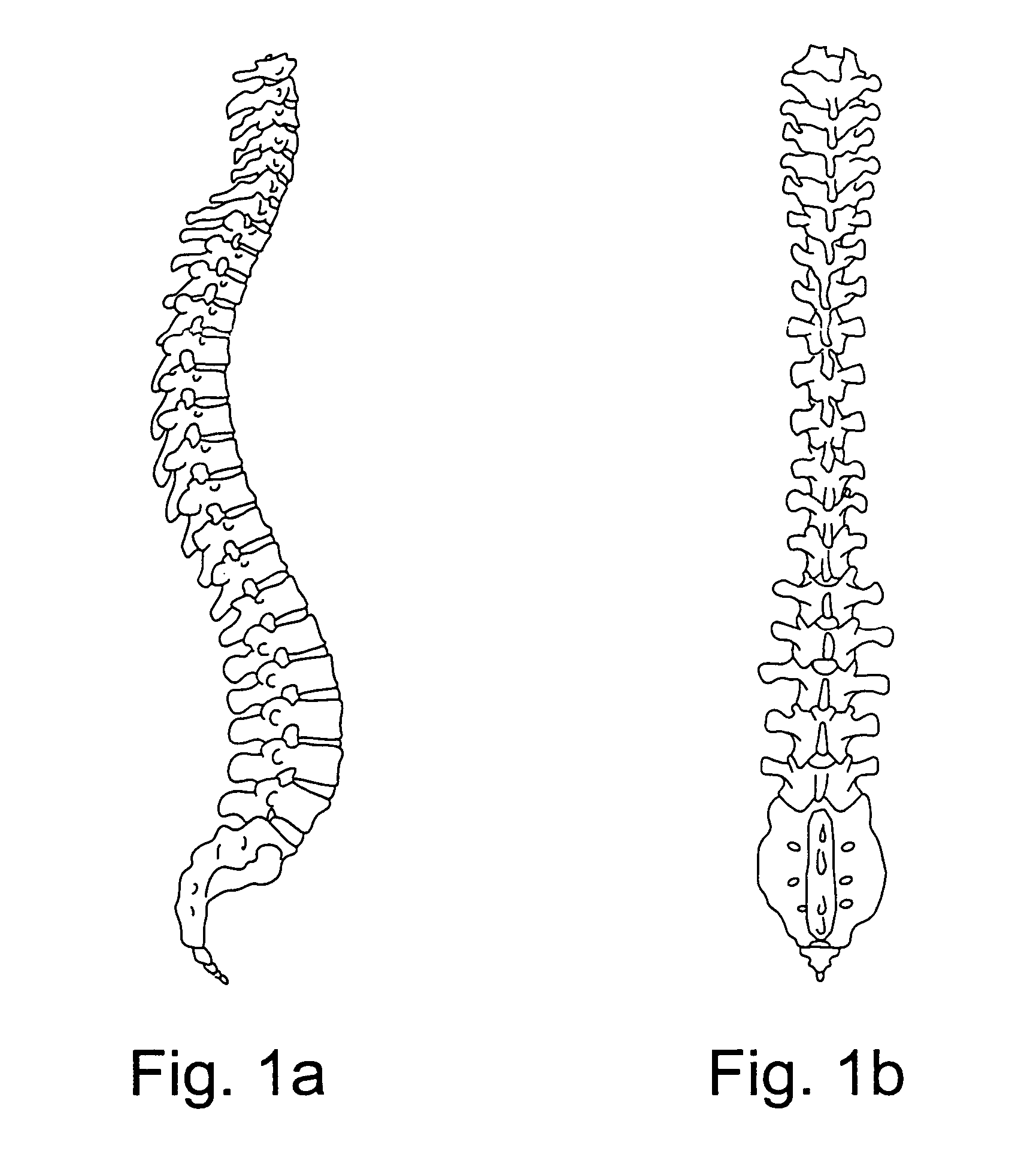 Method of improving pedicle screw placement in spinal surgery