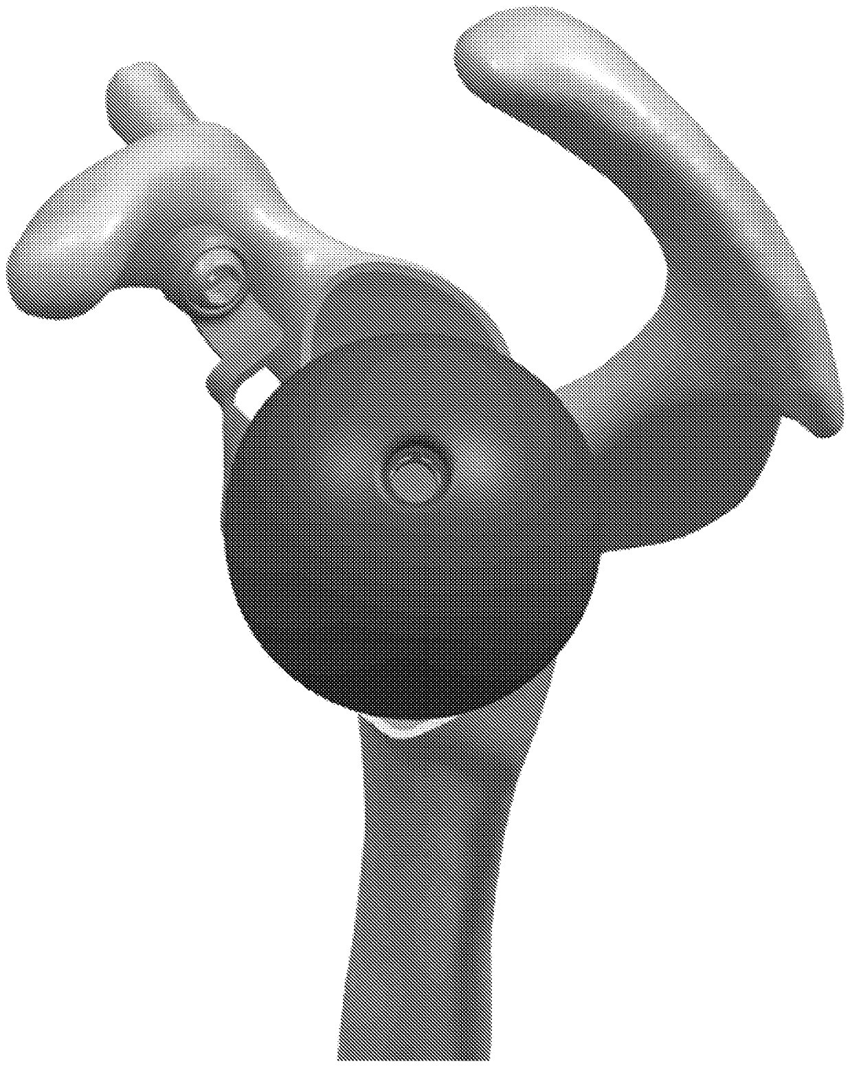 Platform rtsa glenoid prosthesis with modular attachments capable of improving initial fixation, fracture reconstructions, and joint biomechanics