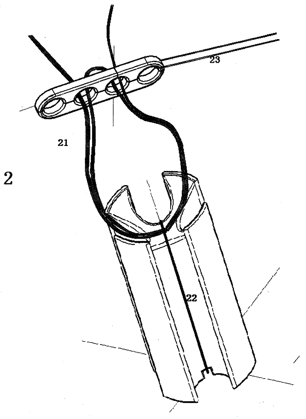 Ligament fixation system comprising suspensory steel plate and absorbable implant