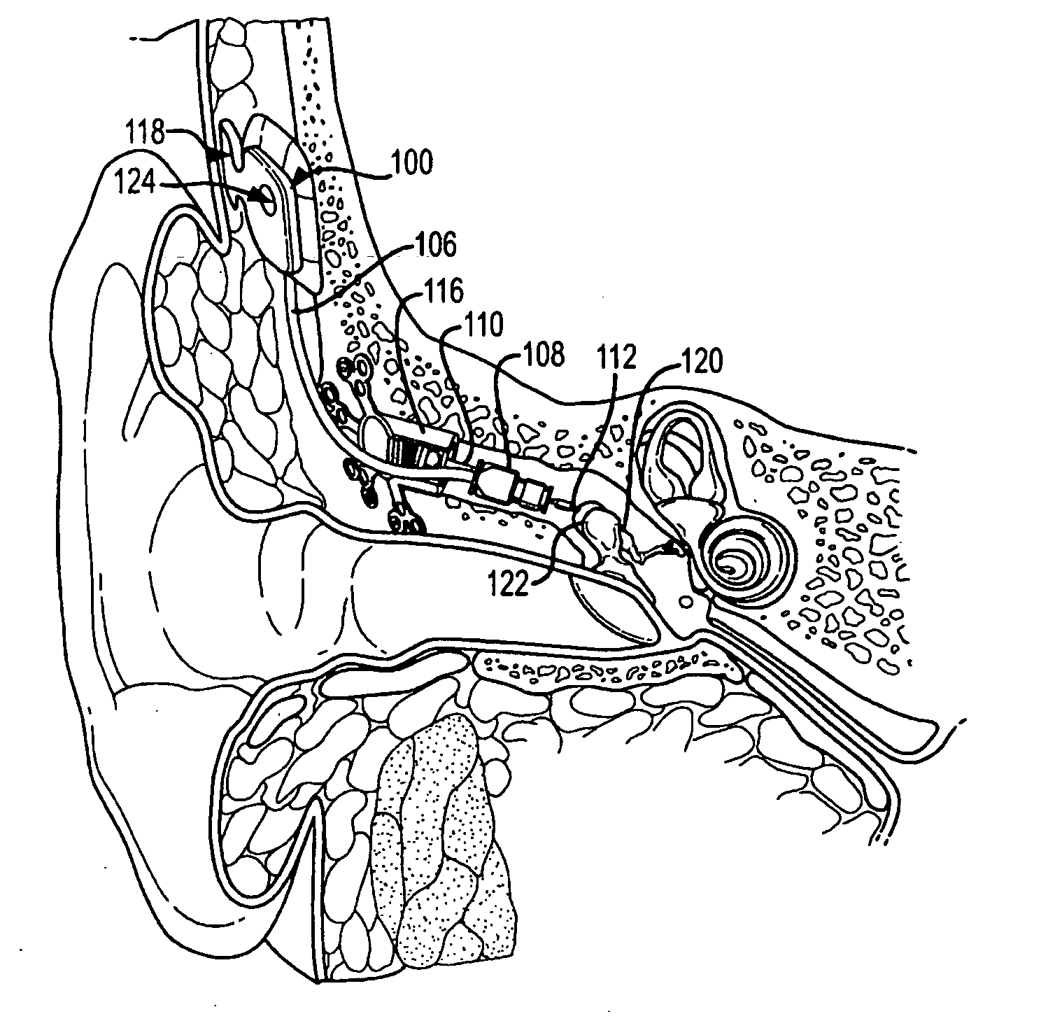 Fluid cushion support for implantable device