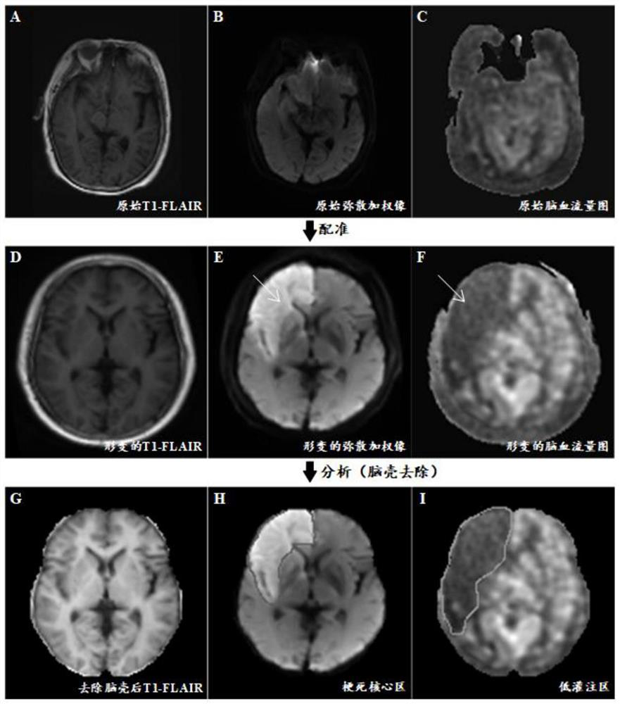 A registration method for MRI perfusion-diffusion images in acute ischemic stroke