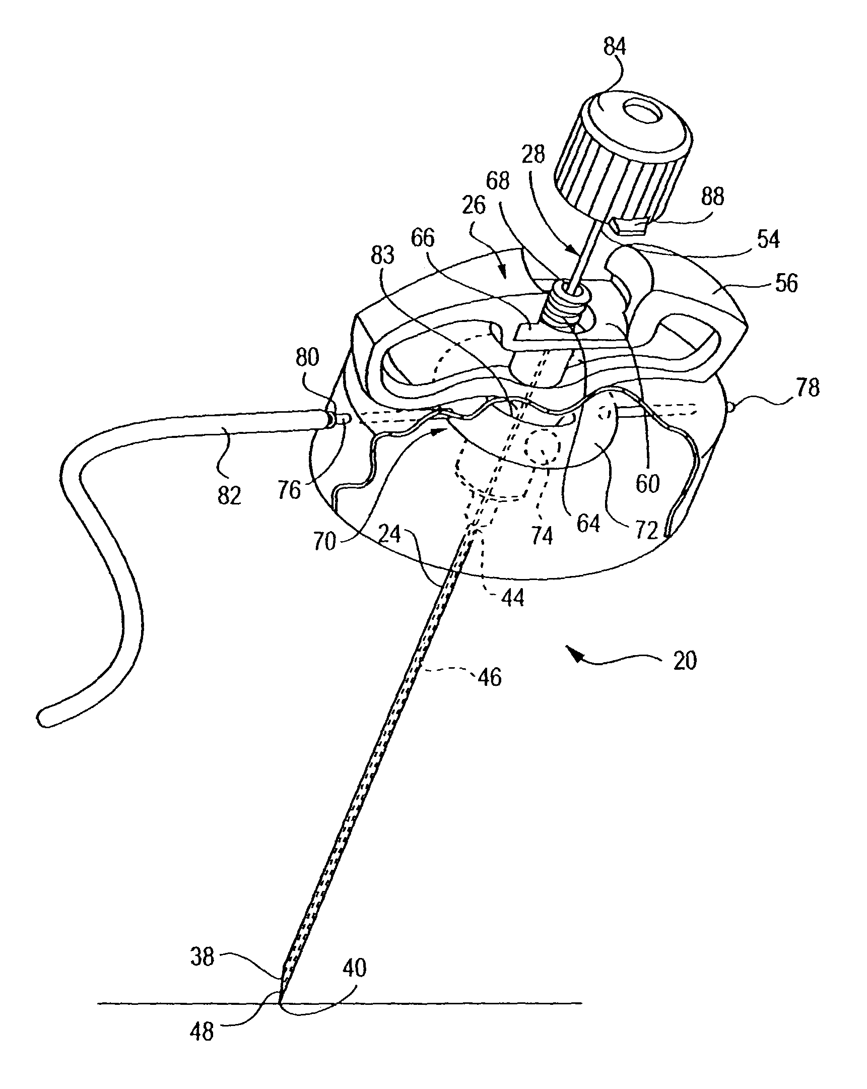 Cement delivery needle