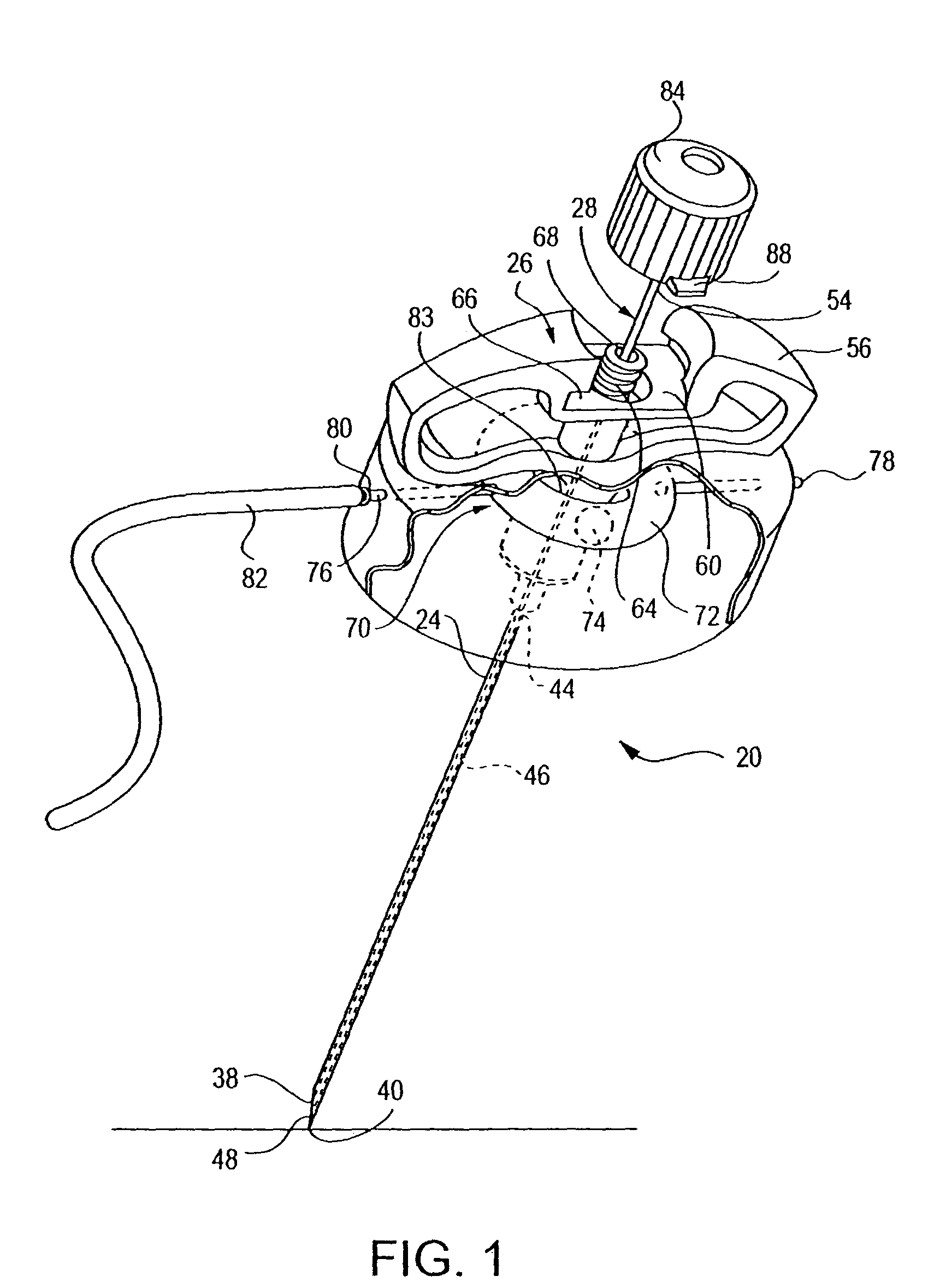 Cement delivery needle