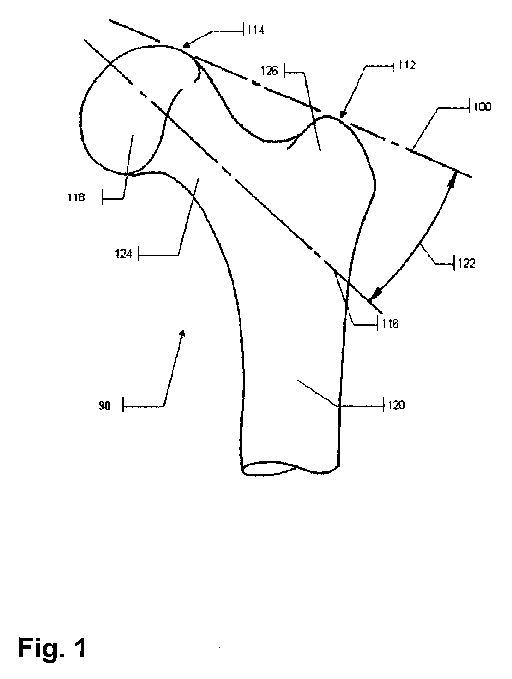 Method and Apparatus for Computer-Assisted Femoral Head Resurfacing