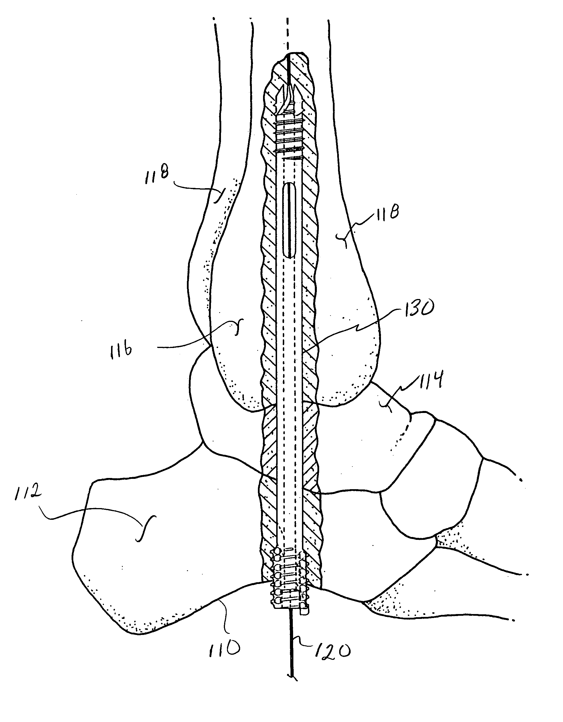 Intramedullary locked compression screw for stabiliziation and union of complex ankle and subtalar deformities