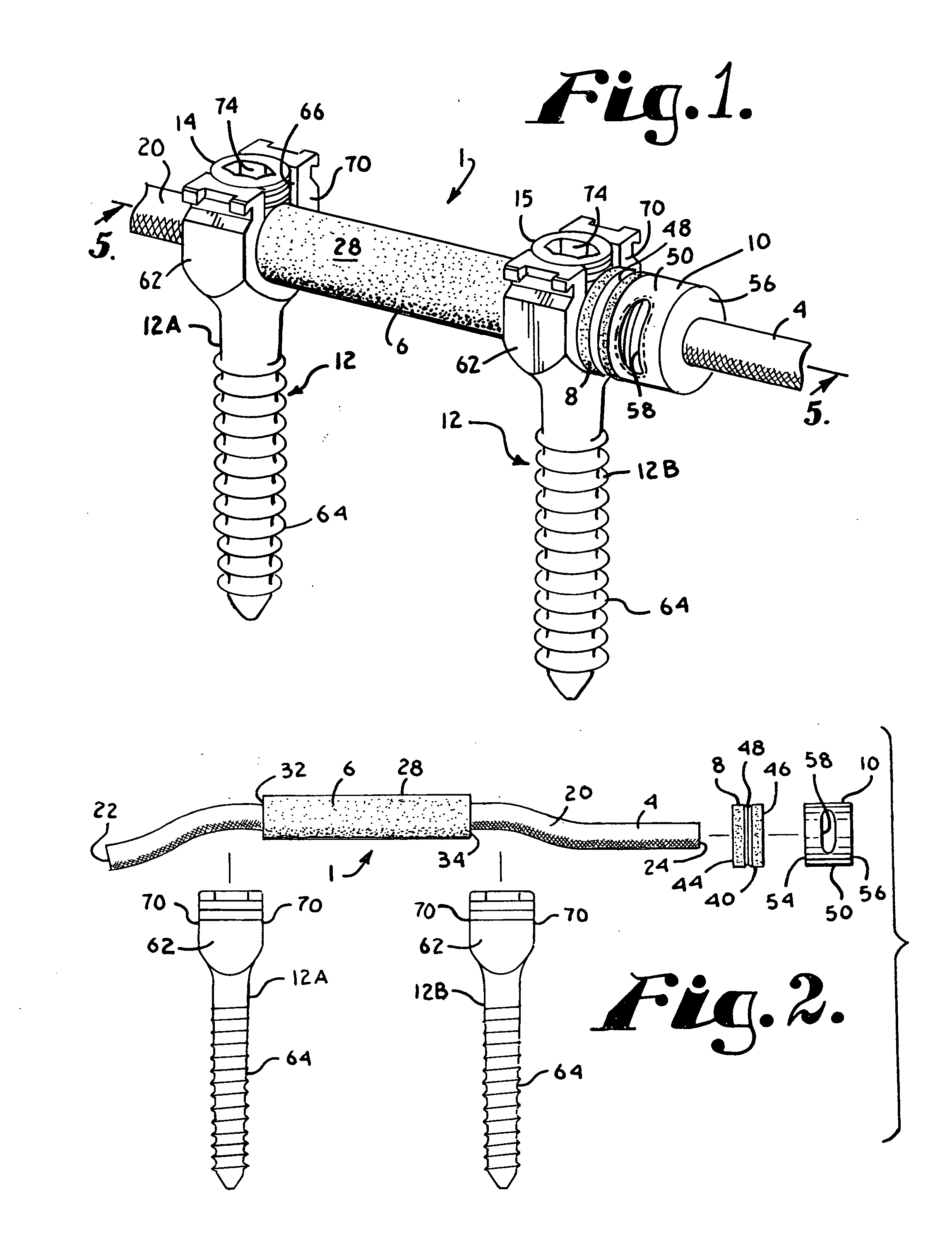 Dynamic spinal stabilization assembly with elastic bumpers and locking limited travel closure mechanisms