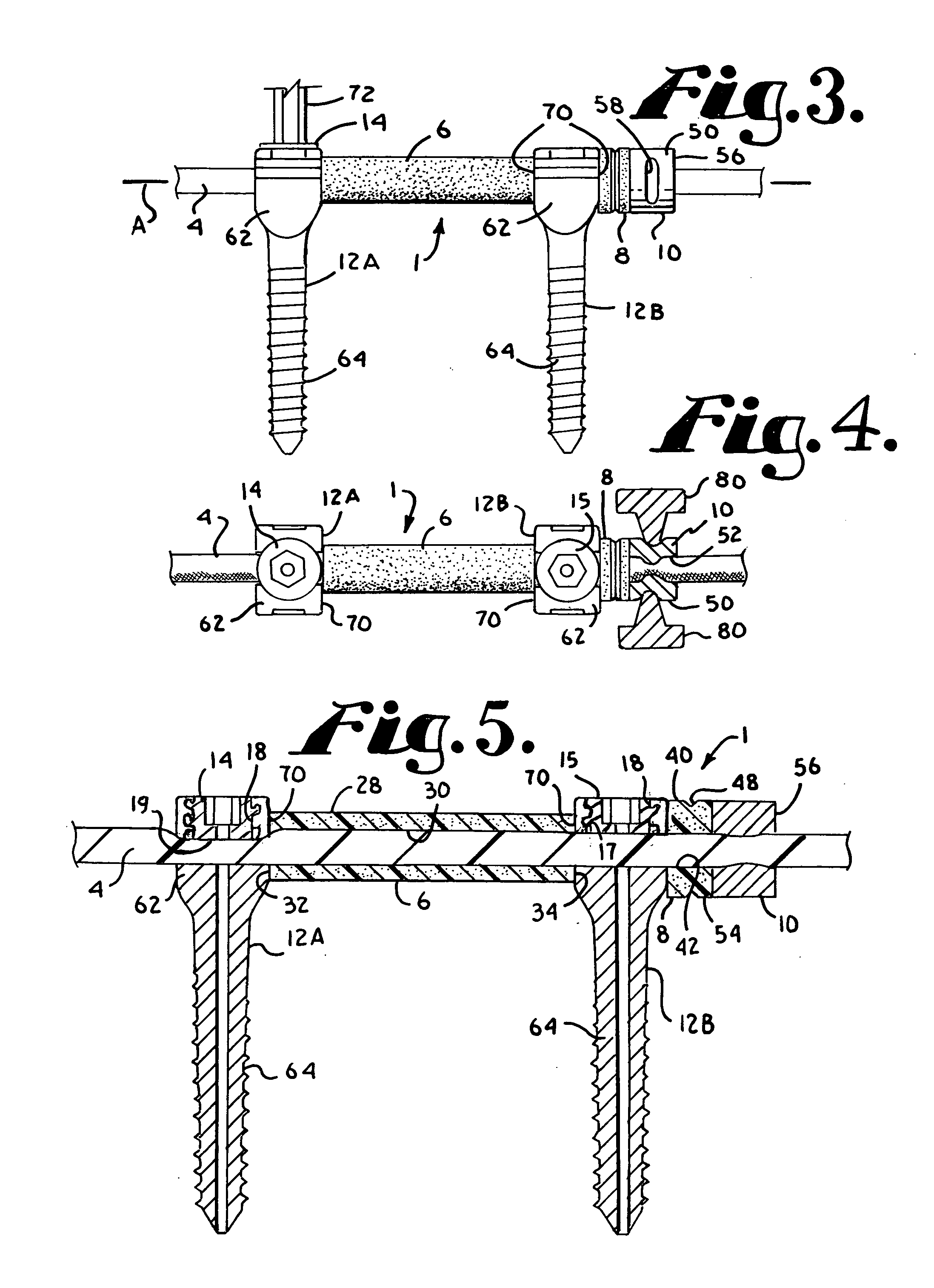 Dynamic spinal stabilization assembly with elastic bumpers and locking limited travel closure mechanisms