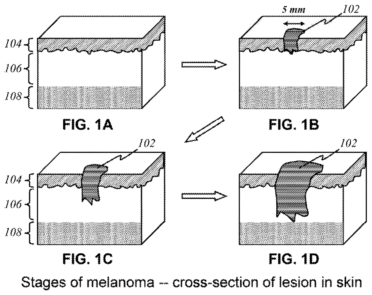 System for screening and diagnosis of skin cancer