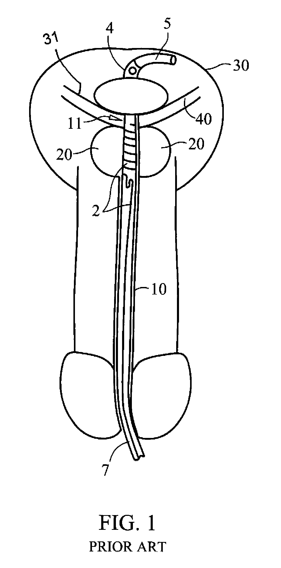 Illuminating balloon catheter and method for using the catheter