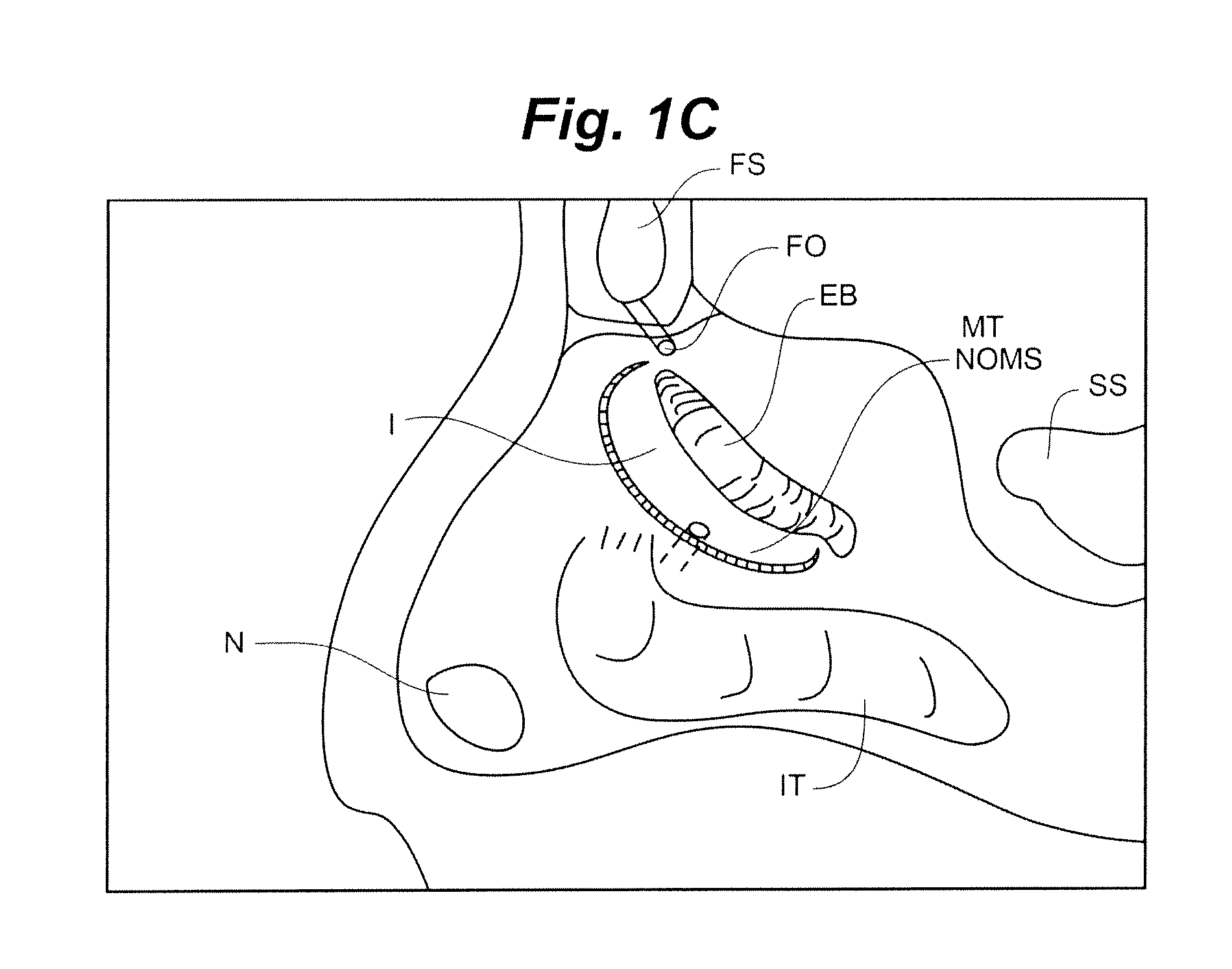 Devices and Methods for Minimally Invasive Access to Sinuses and Treatment of Sinusitis