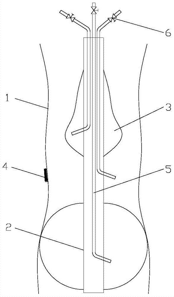 Leakage detecting device for digestive tract anastomotic stoma and leakage detecting method thereof