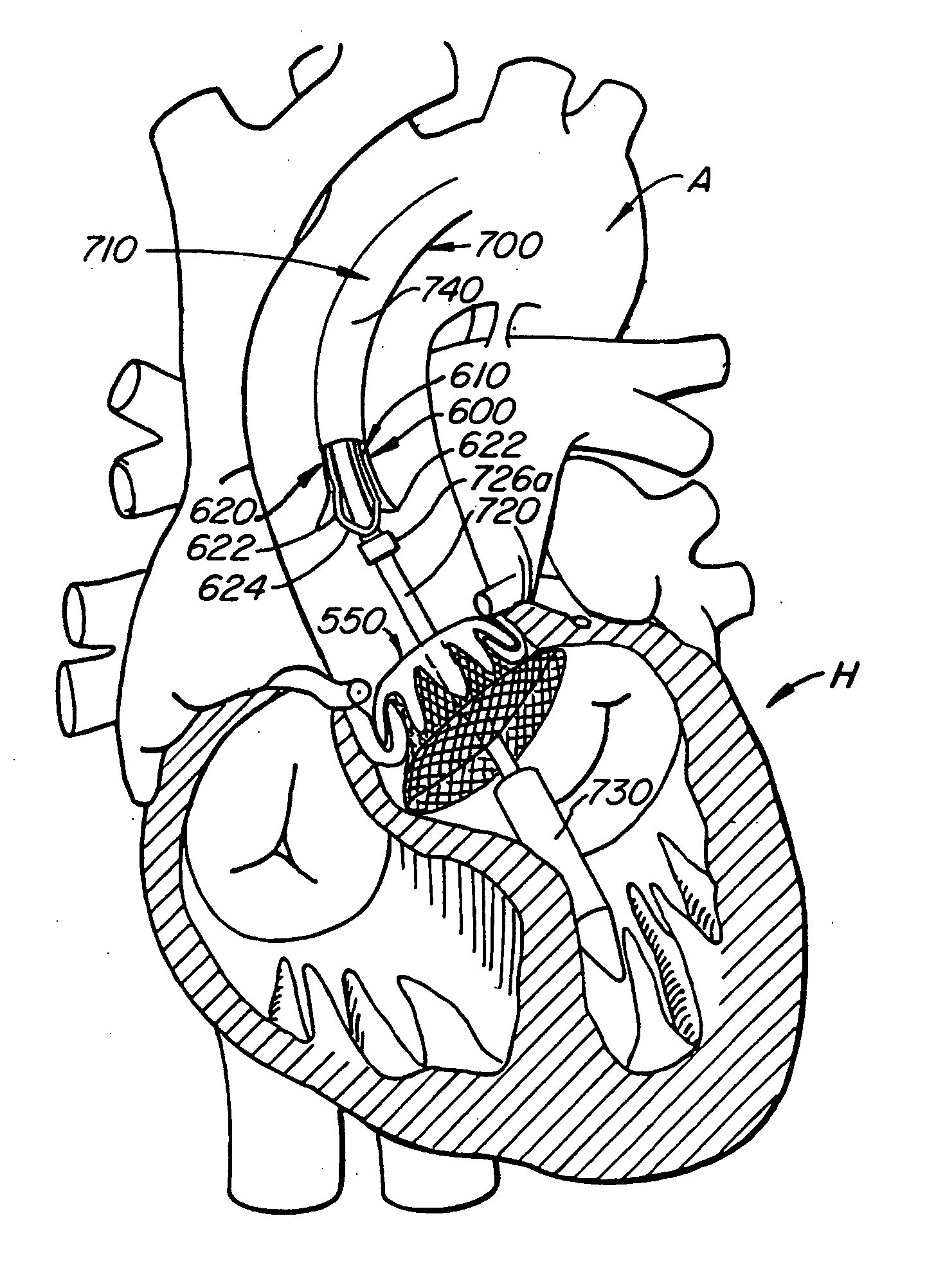 Retrievable heart valve anchor and method