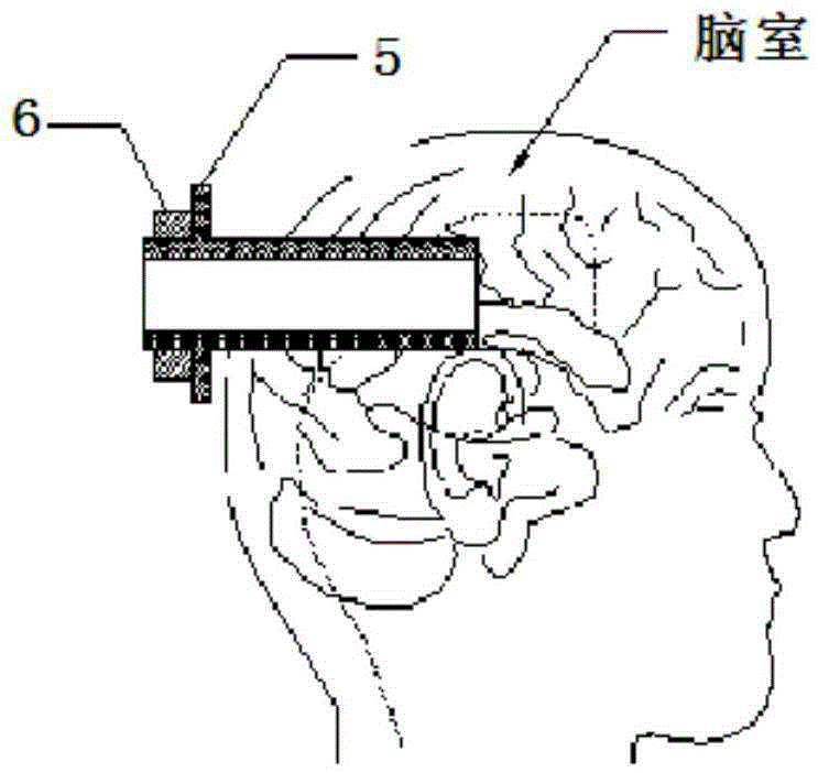 A Visual Ventricle and Subdural Epidural Drainage System