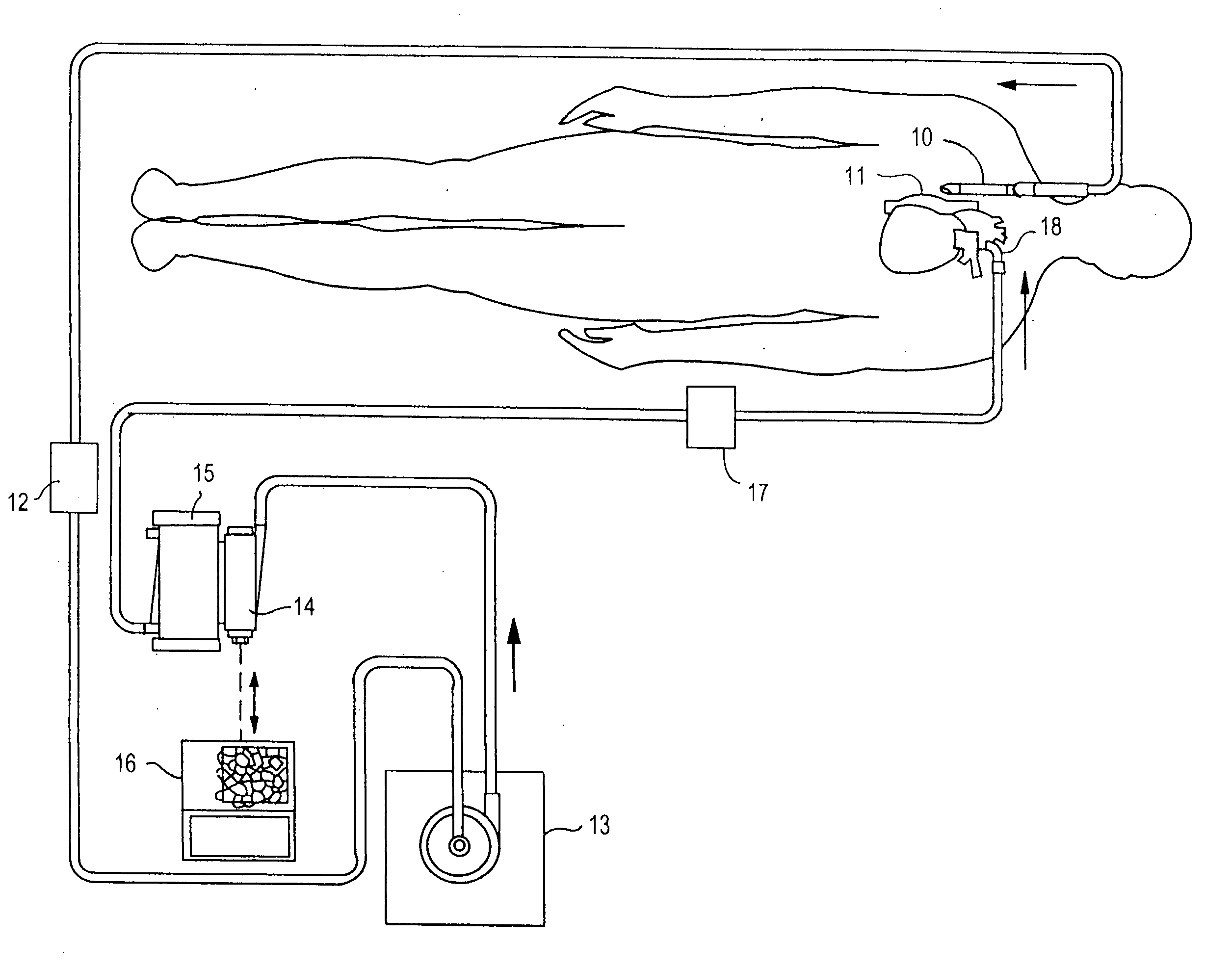 Float-driven lever arm for blood perfusion air removal device