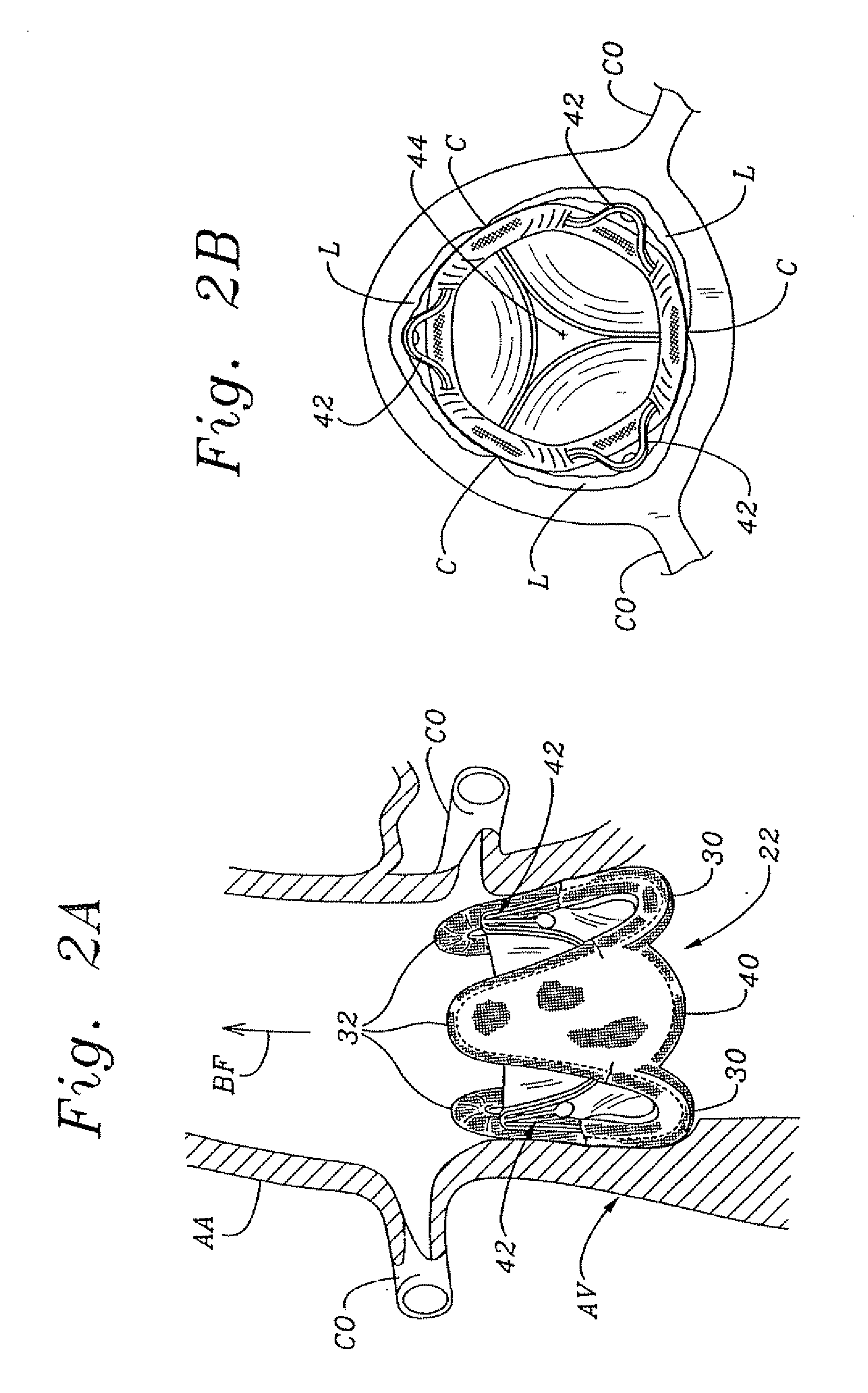 Minimally-invasive heart valve with cusp positioners