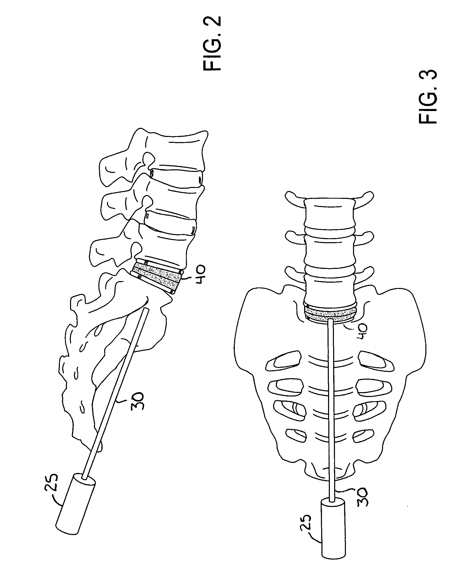 Method of percutaneous paracoccygeal pre-sacral stabilization of a failed artificial disc replacement