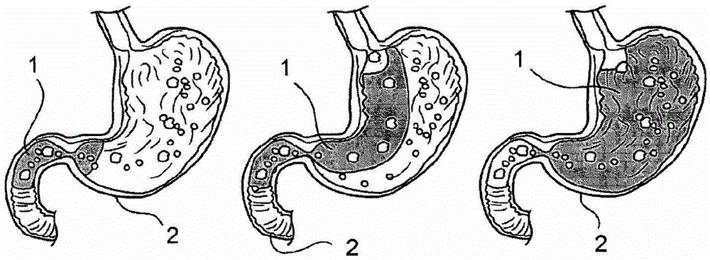 Cavity liners and methods of lining hollow organ cavities