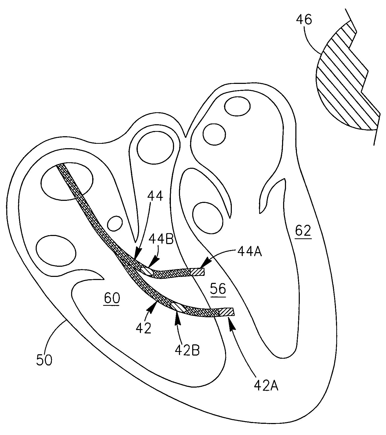 Apparatus and Method for Delivering Electrical Signals to a Heart