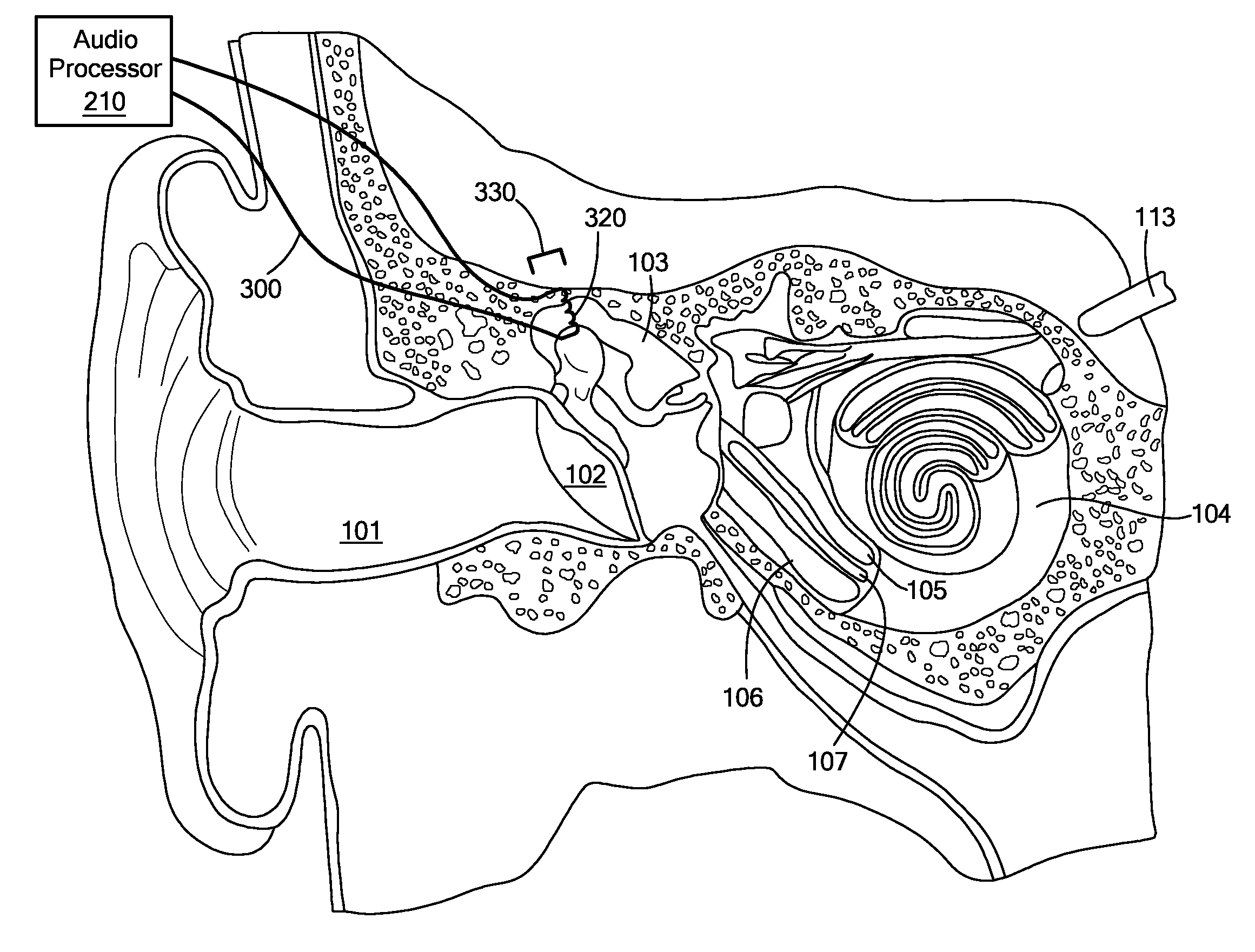 Moving coil actuator for middle ear implants