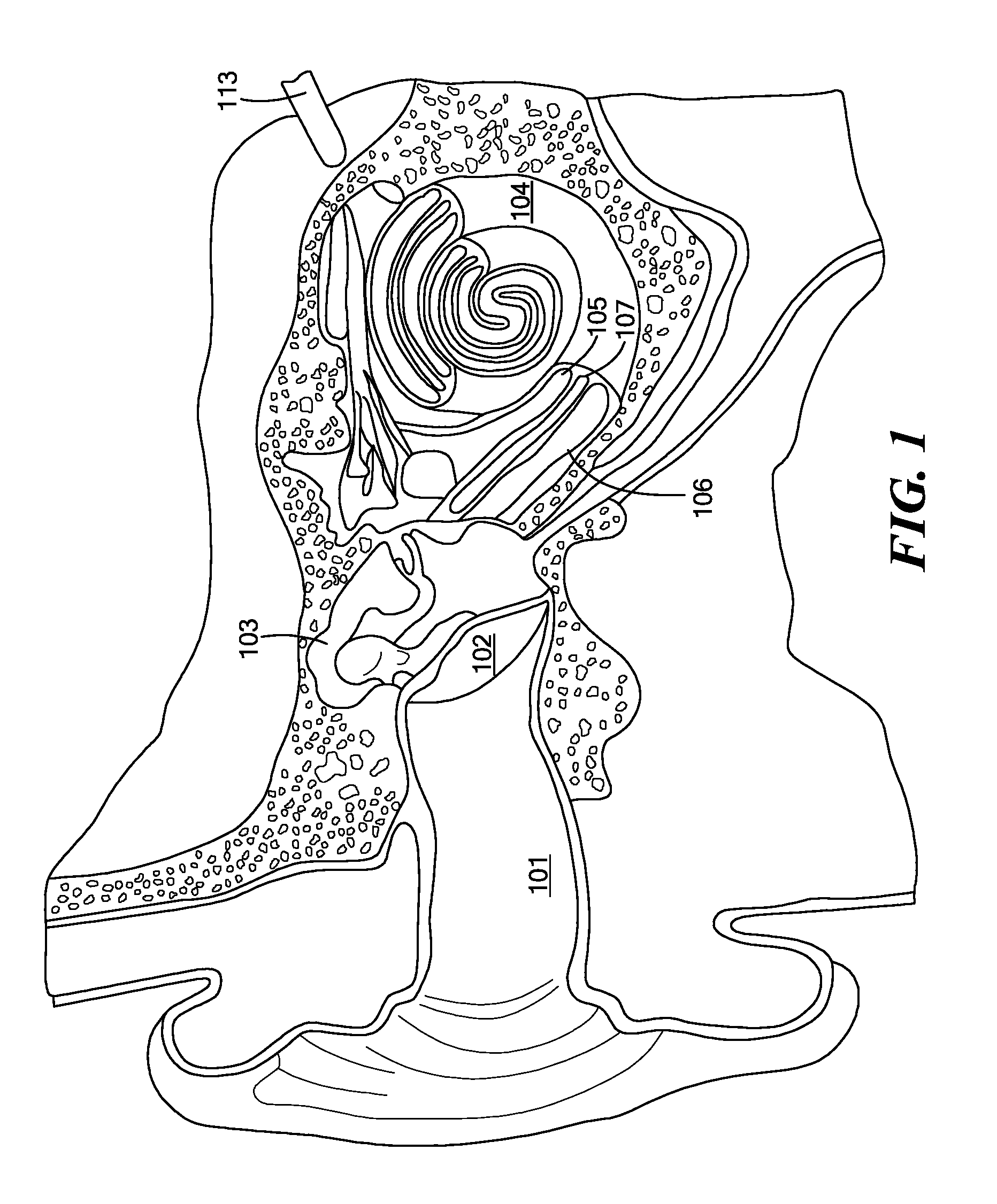 Moving coil actuator for middle ear implants