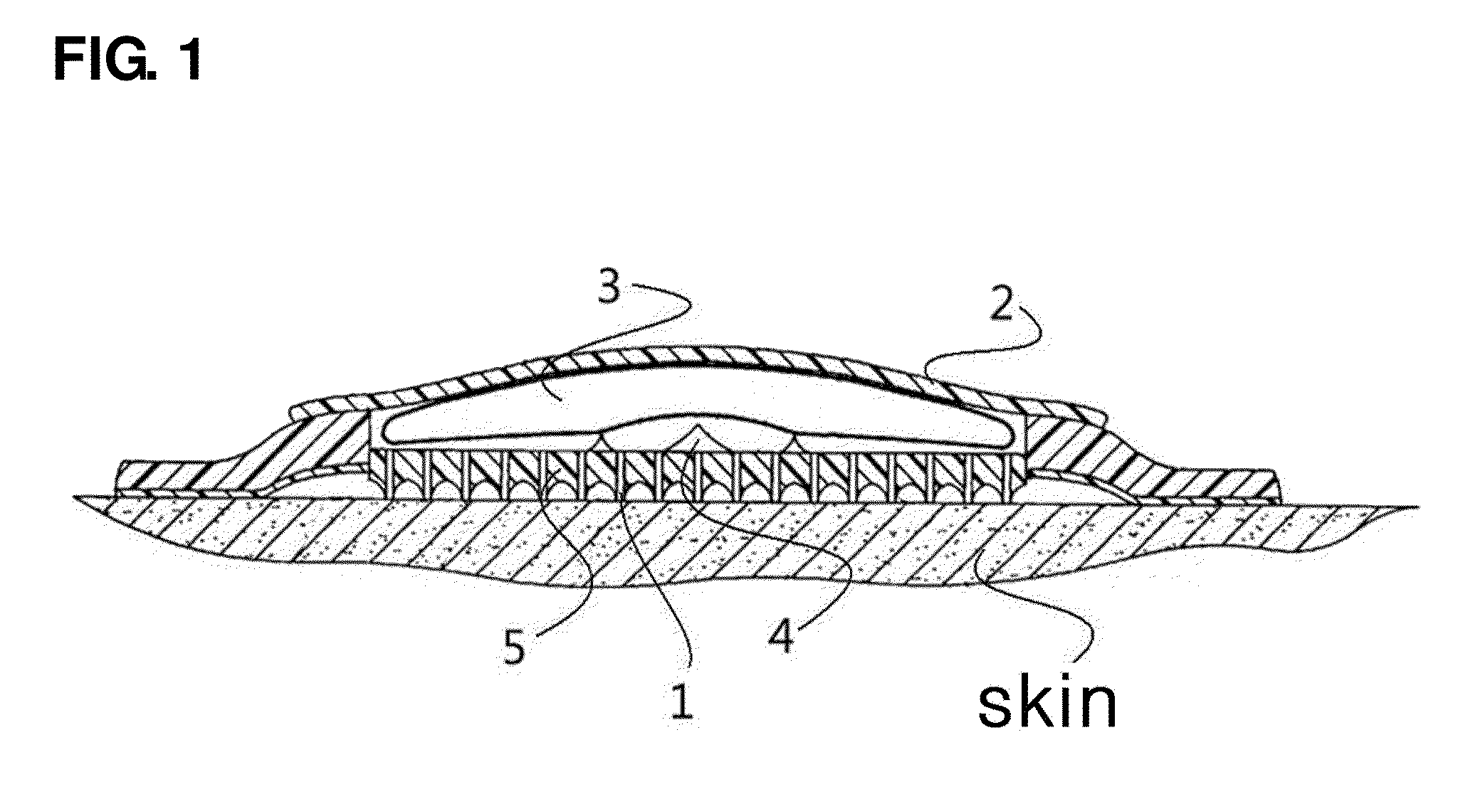 Microneedle drug delivery system including movable drug-containing capsule