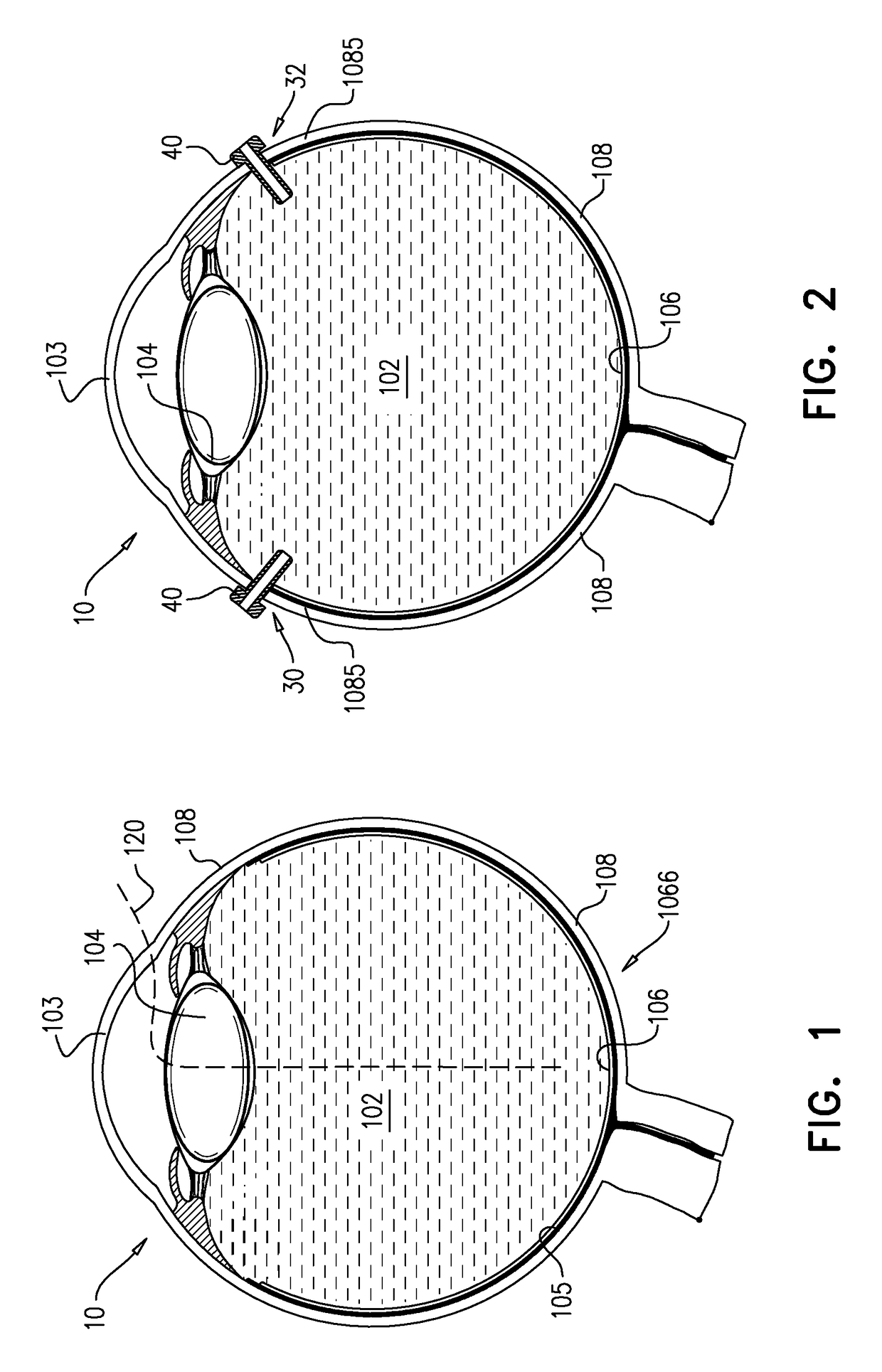 Surgical techniques for implantation of a retinal implant