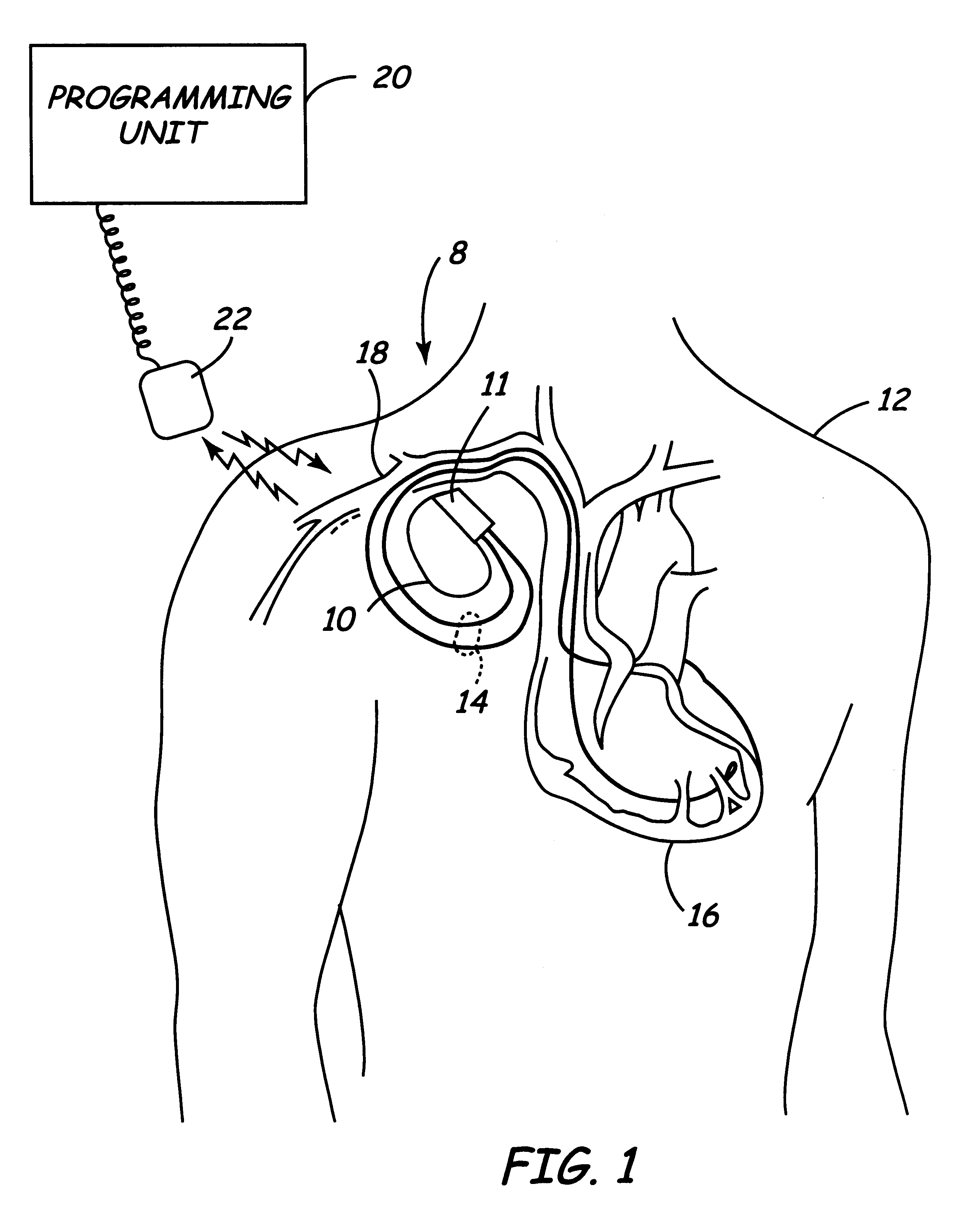 Method and apparatus for displaying information retrieved from an implanted medical device