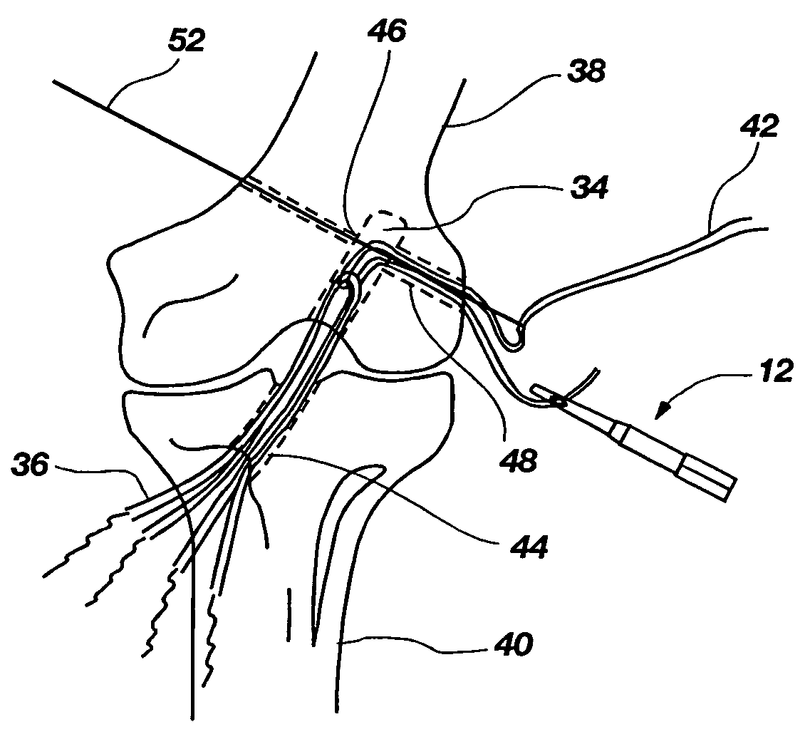 Method and implant for securing ligament replacement into the knee